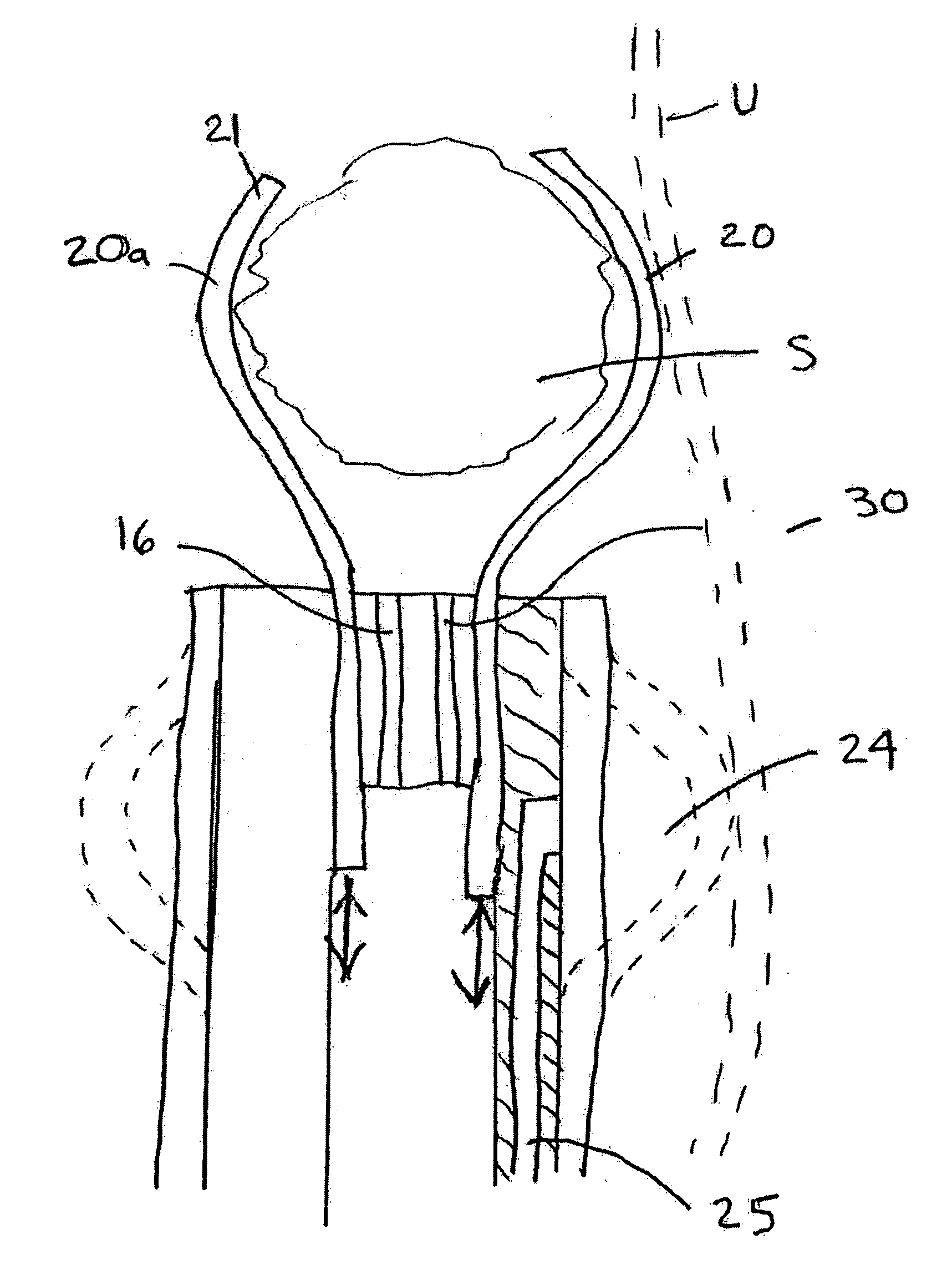 Apparatus and method for stone capture and removal