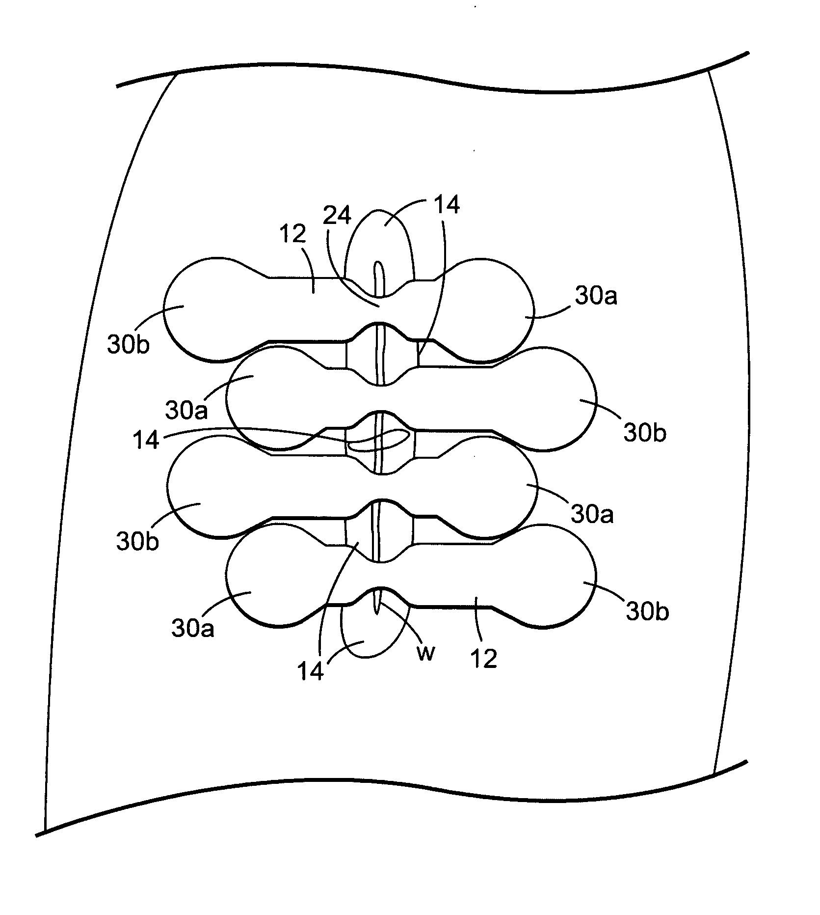 Wound closure system and method