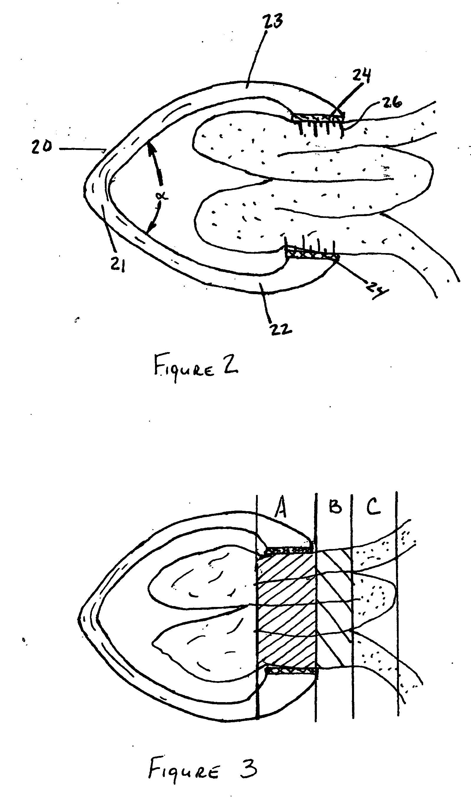 Methods and apparatus for excising tissue and creating wall-to-wall adhesions from within an organ