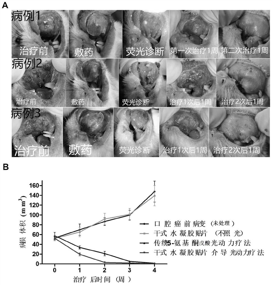 A dry gel patch for photodynamic therapy of oral precancerous lesions and its preparation method