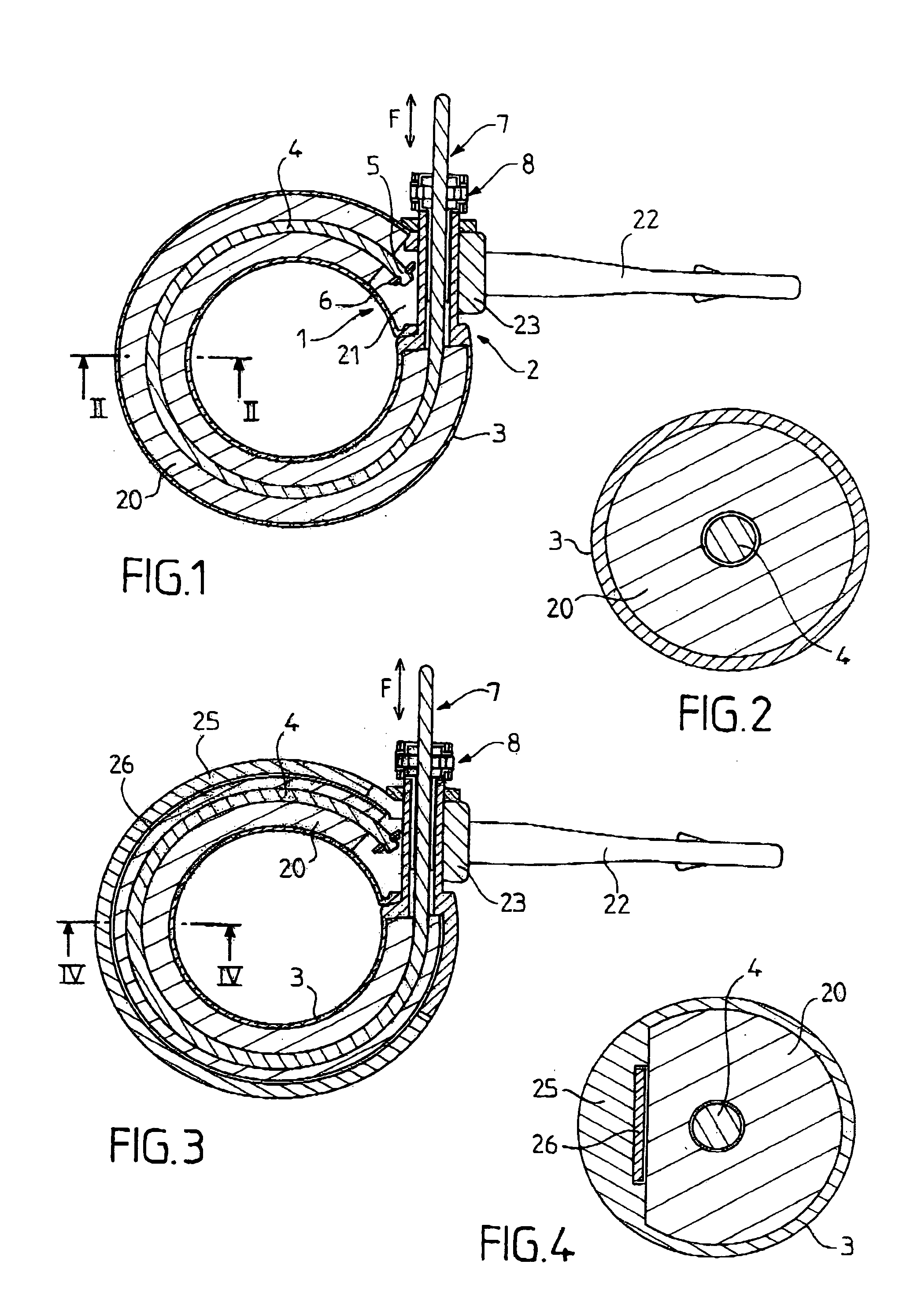 Surgical ring featuring a reversiblediameter remote control system