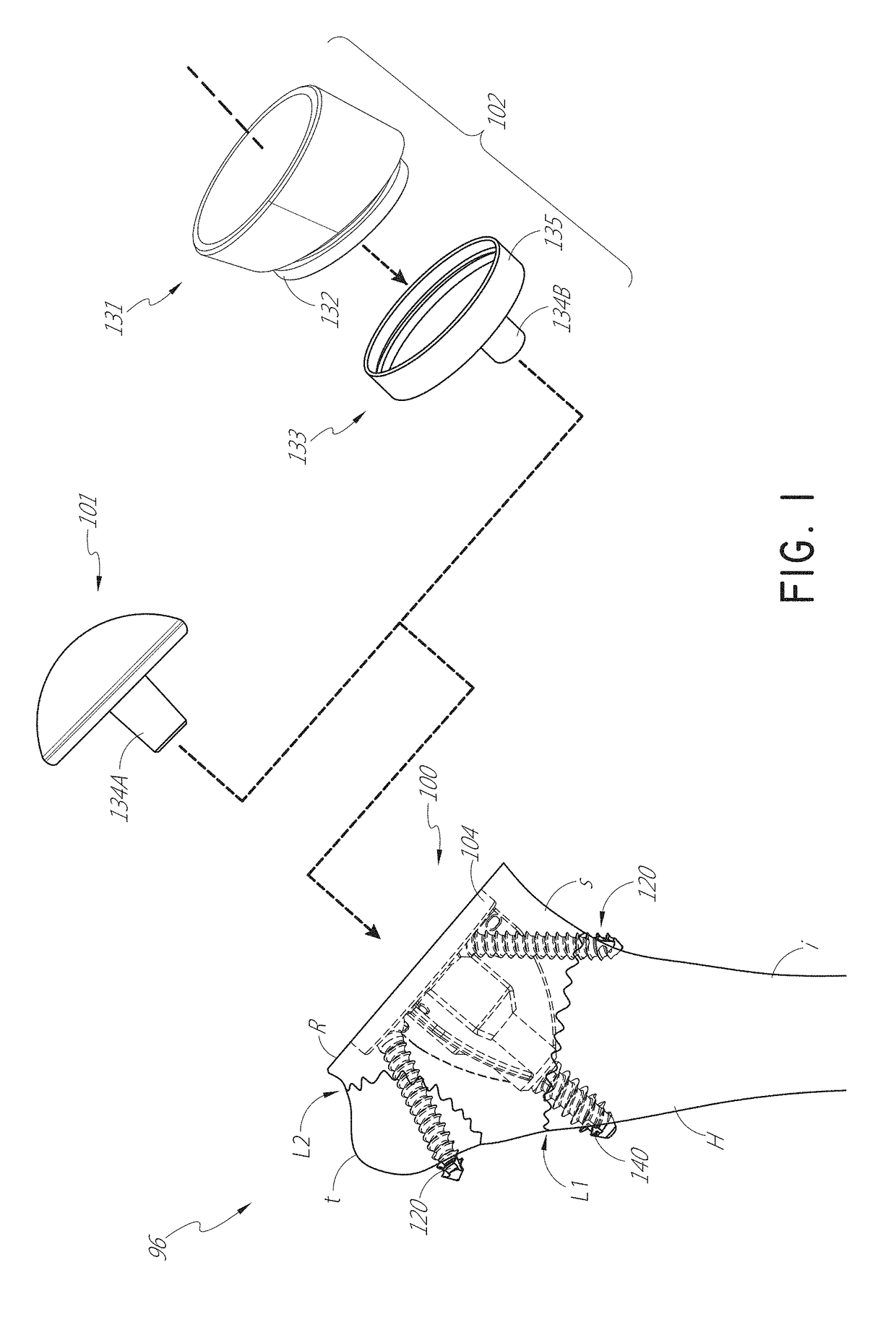 Stemless shoulder implant with fixation components