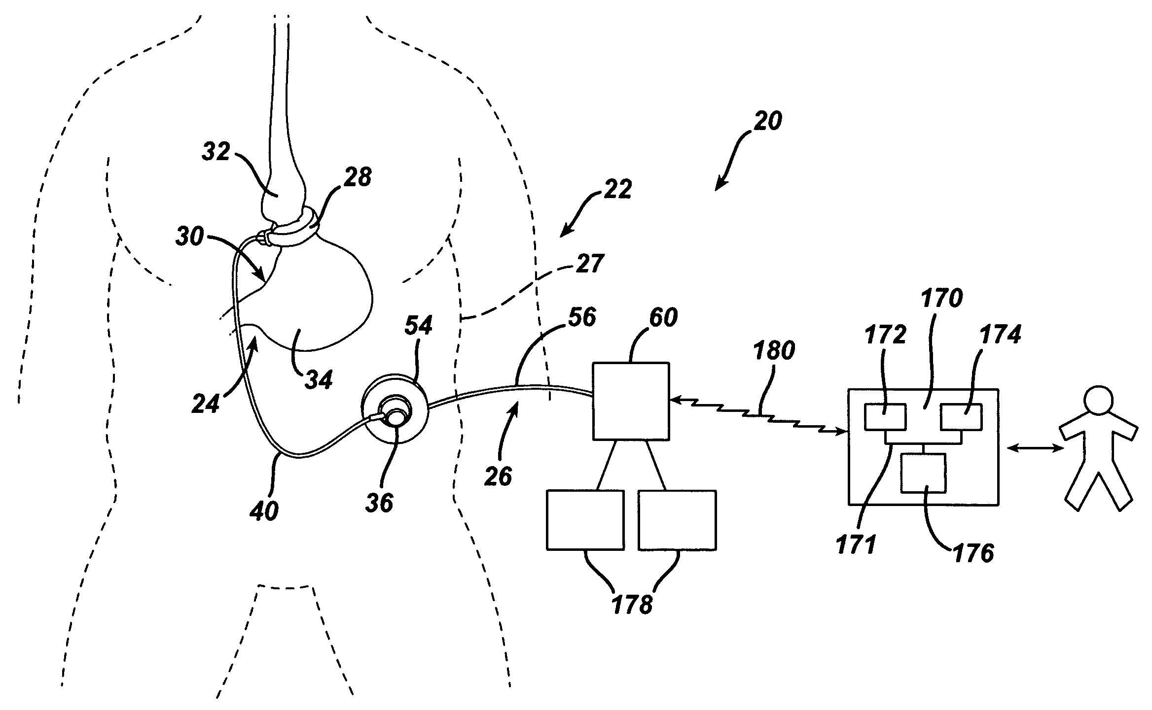 Gui With Trend Analysis for an Implantable Restriction Device and a Data Logger