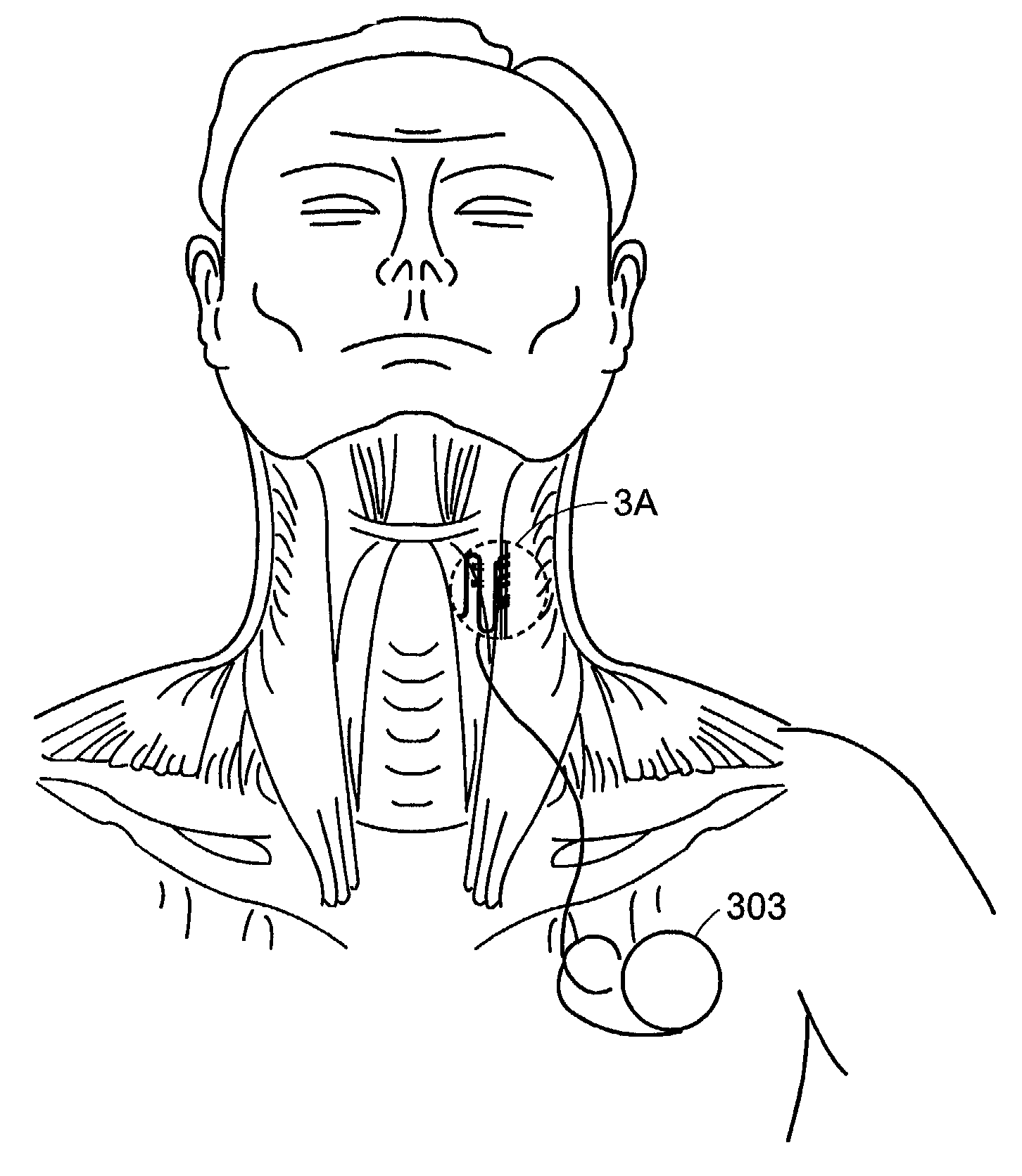 Pacemaker for bilateral vocal cord autoparalysis