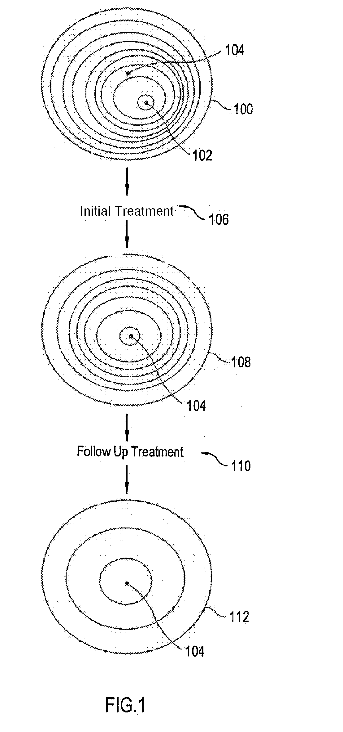 Method and Apparatus for Multi-Step Correction of Ophthalmic Refractive Errors