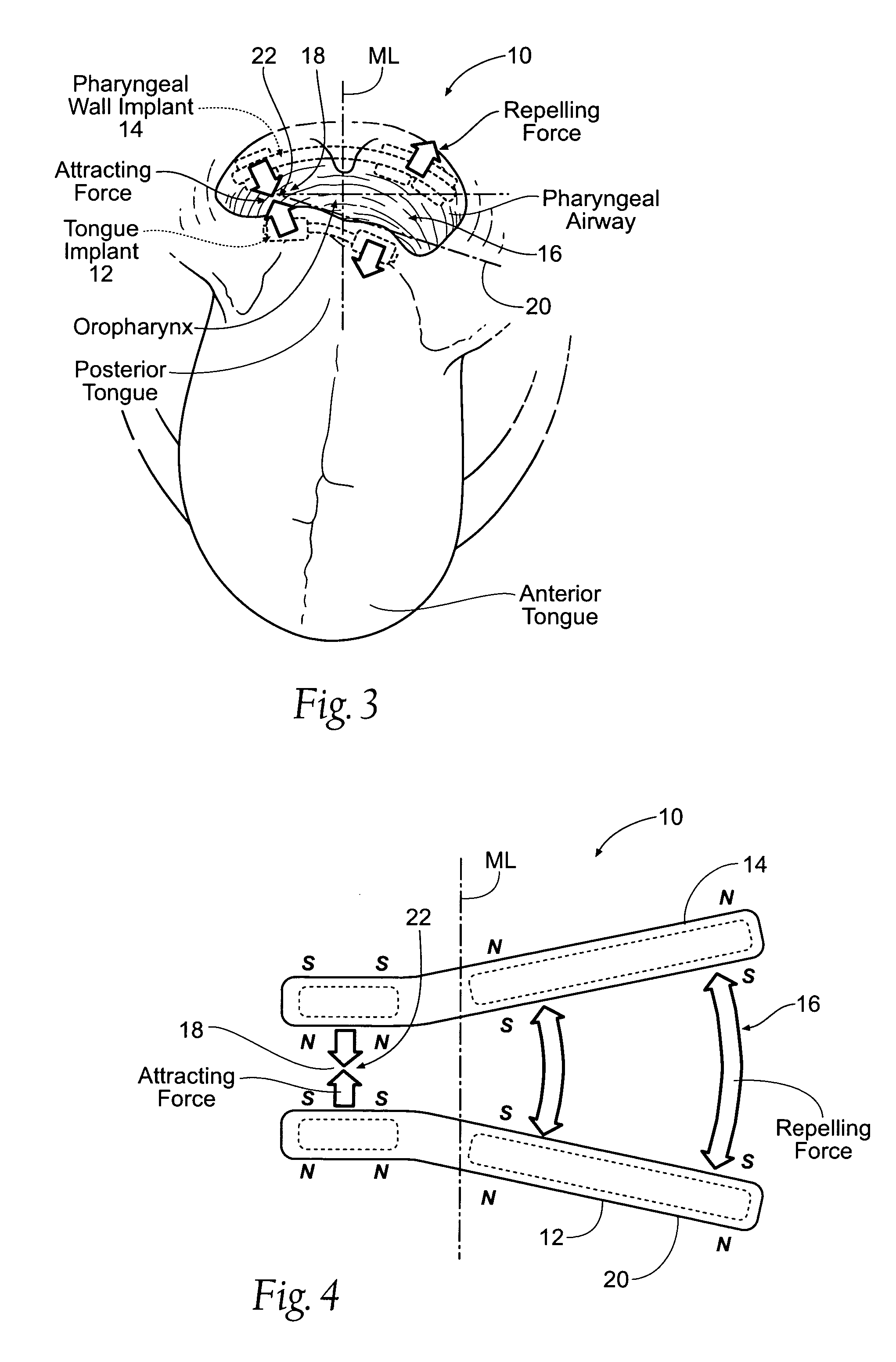 Self-anchoring magnetic force implant devices, systems, and methods