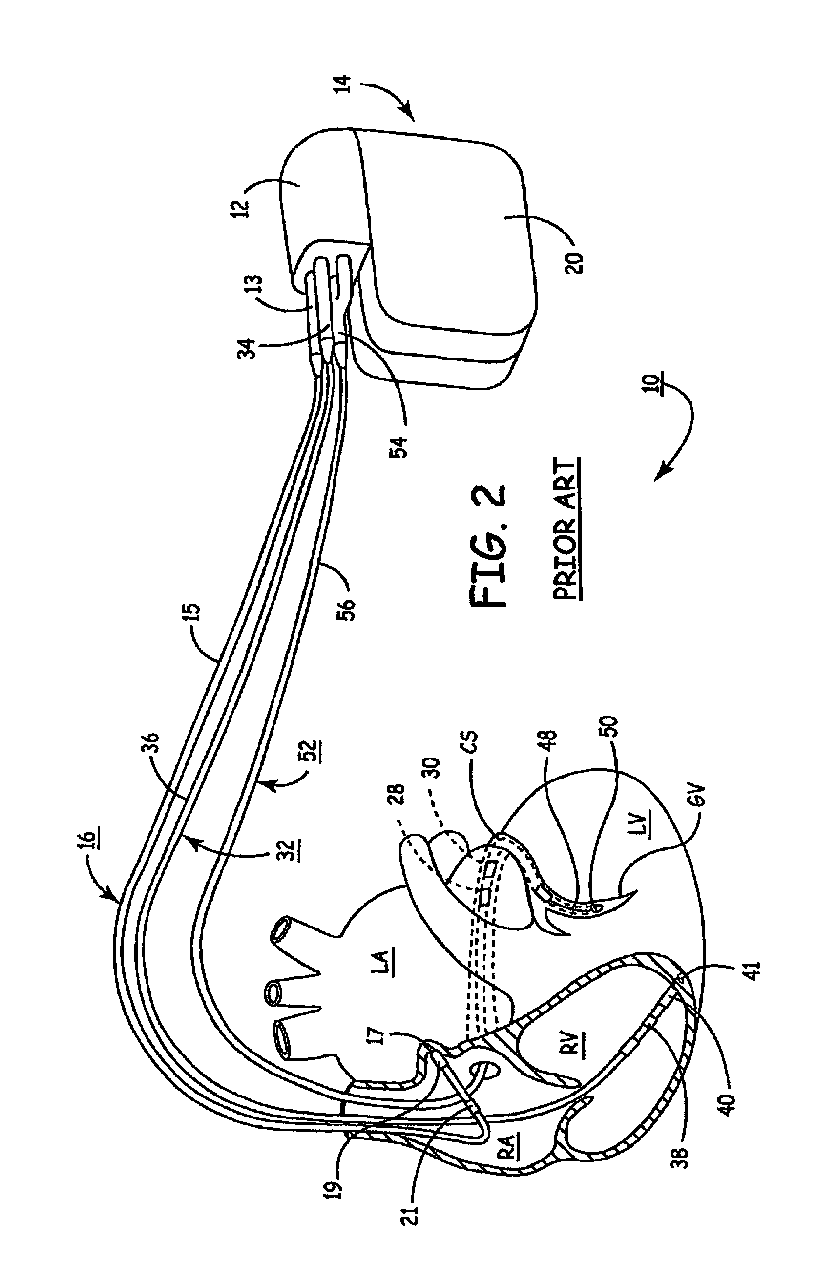 Apparatus and methods of energy efficient, atrial-based Bi-ventricular fusion-pacing