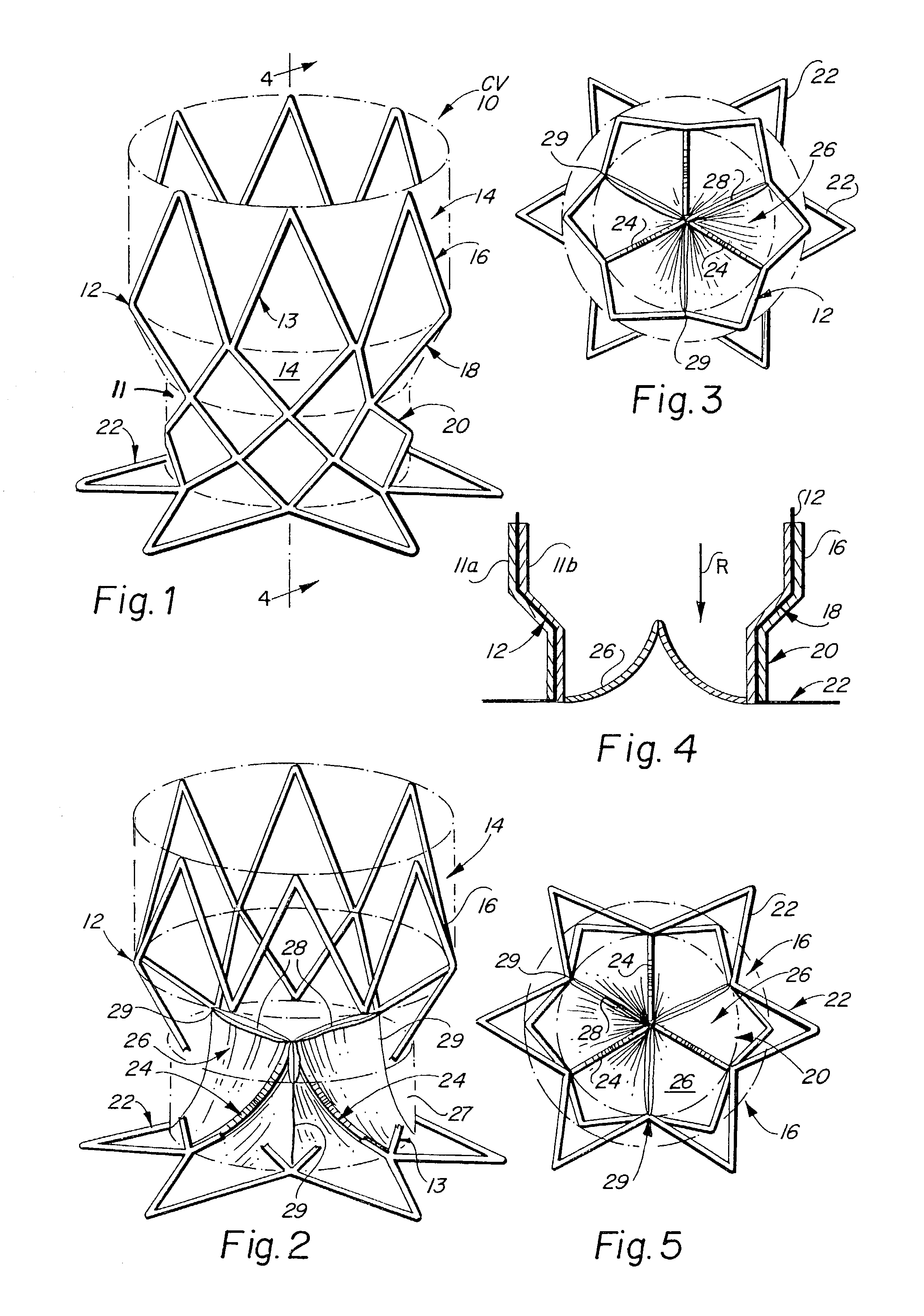 Endoluminal cardiac and venous valve prostheses and methods of manufacture and delivery thereof