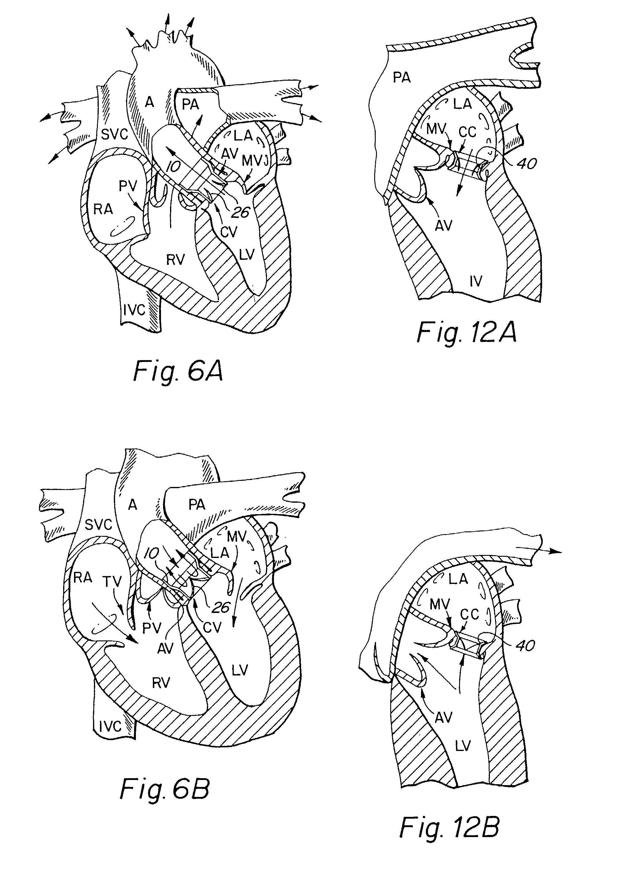 Endoluminal cardiac and venous valve prostheses and methods of manufacture and delivery thereof