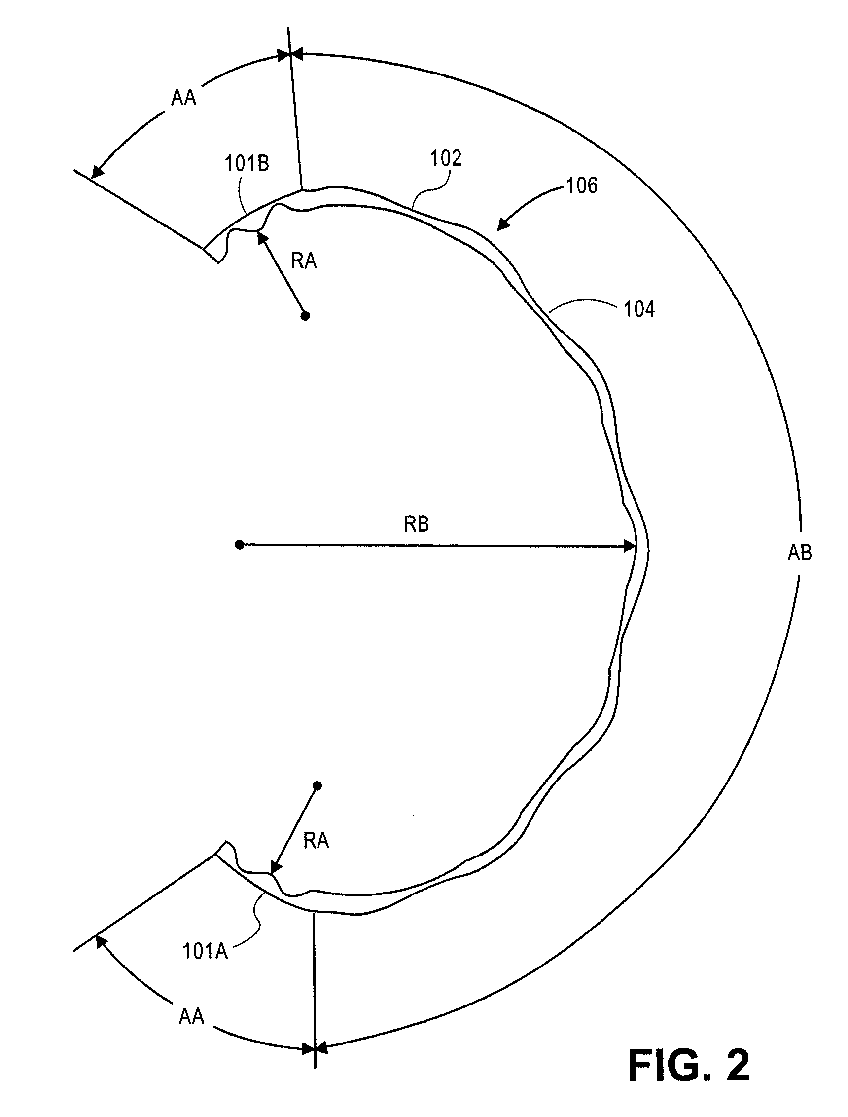 Methods and apparatus for treating glaucoma