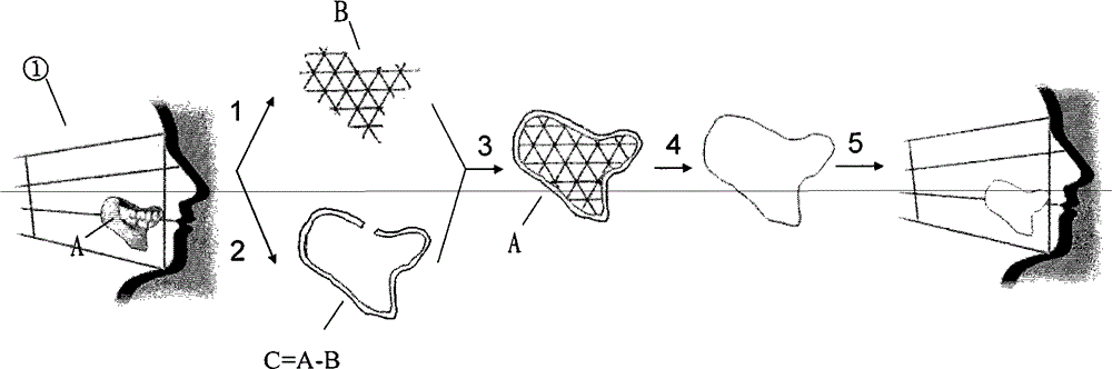 Complex-shaped gel-metal composite prosthesis and manufacturing method thereof