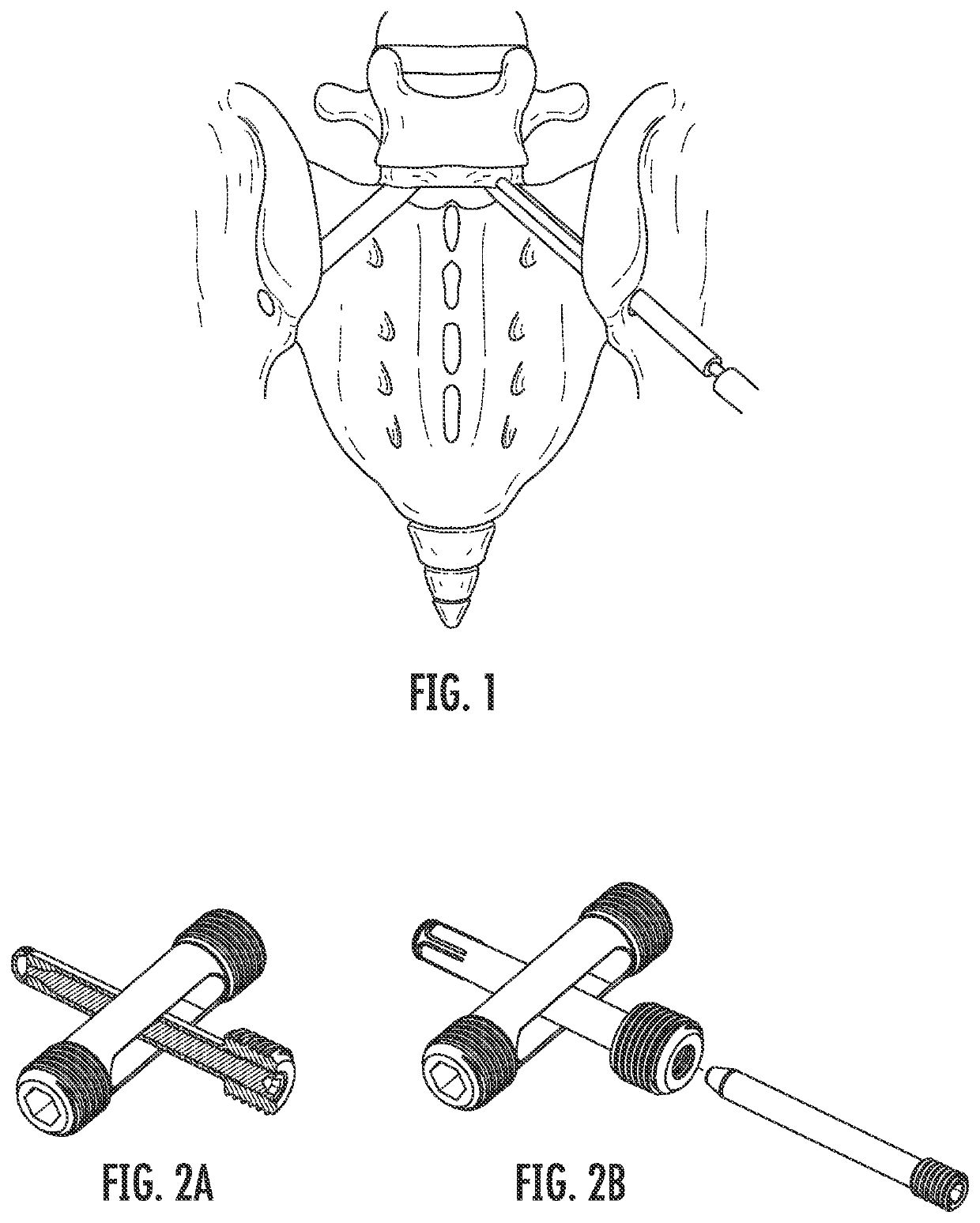 Method for performing spinal surical procedures through the sacral ala
