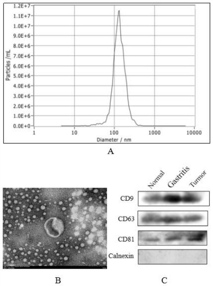 Plasma exosome circRNA marker for diagnosis and prognosis monitoring of gastric cancer and application of plasma exosome circRNA marker