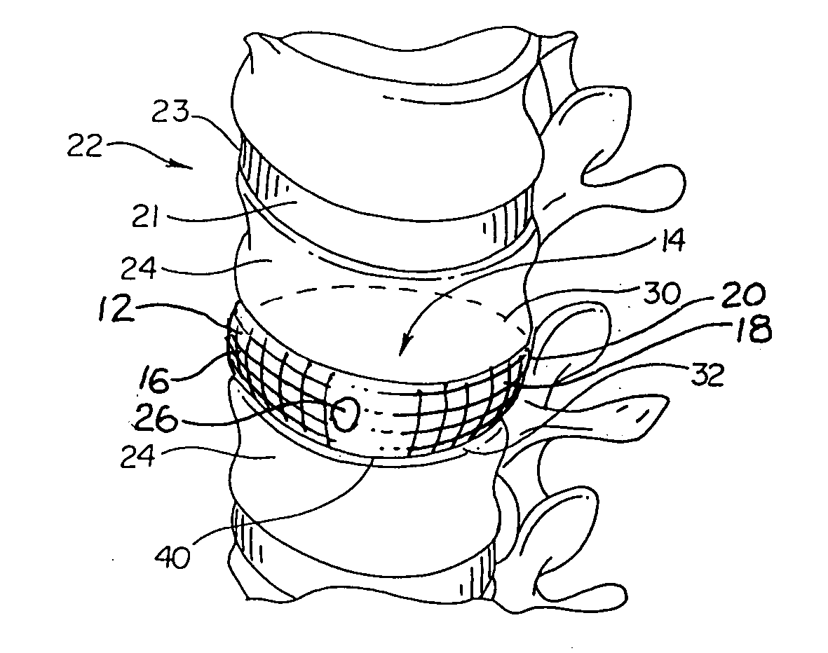 Annulus-reinforcing band