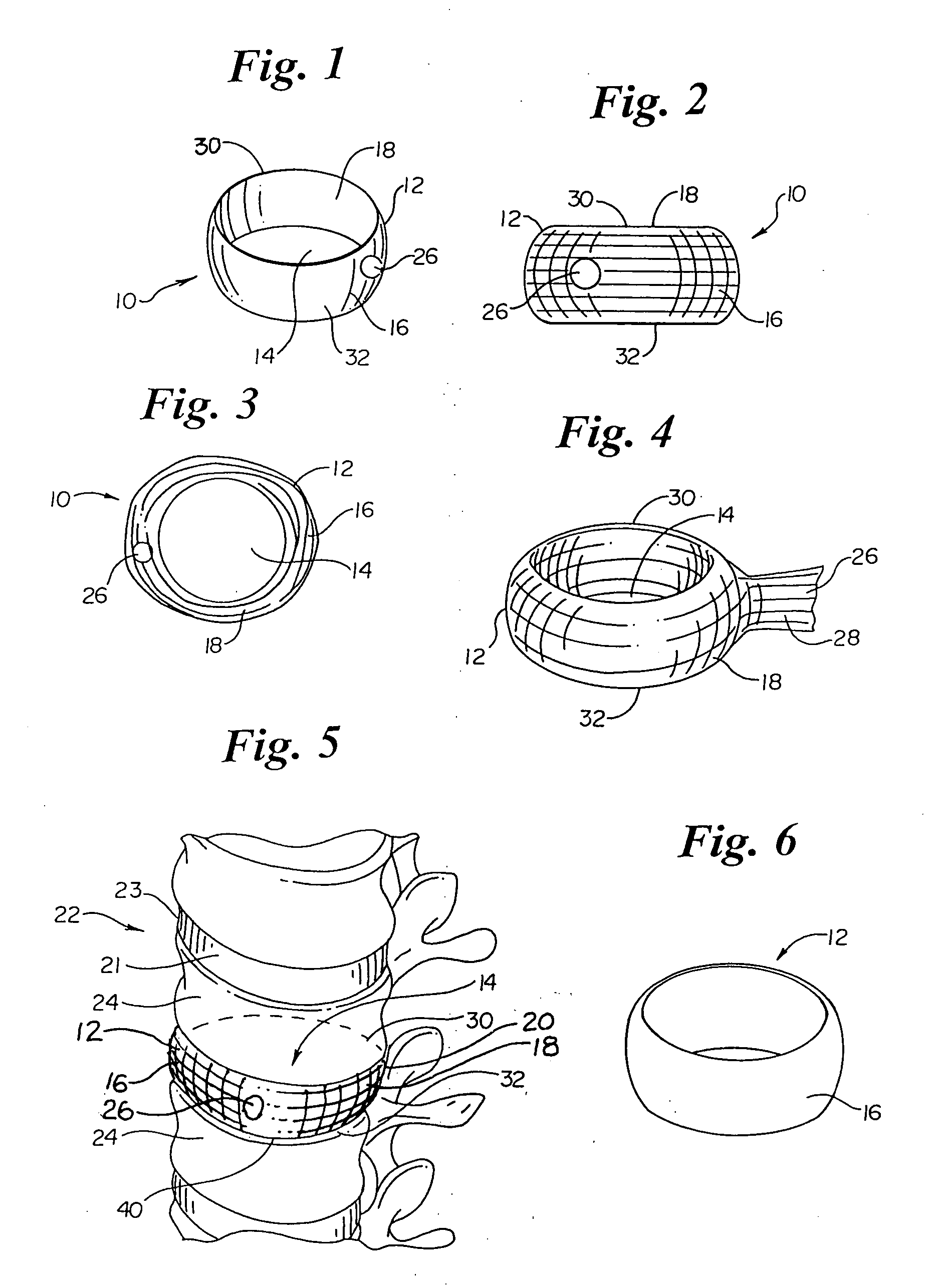 Annulus-reinforcing band