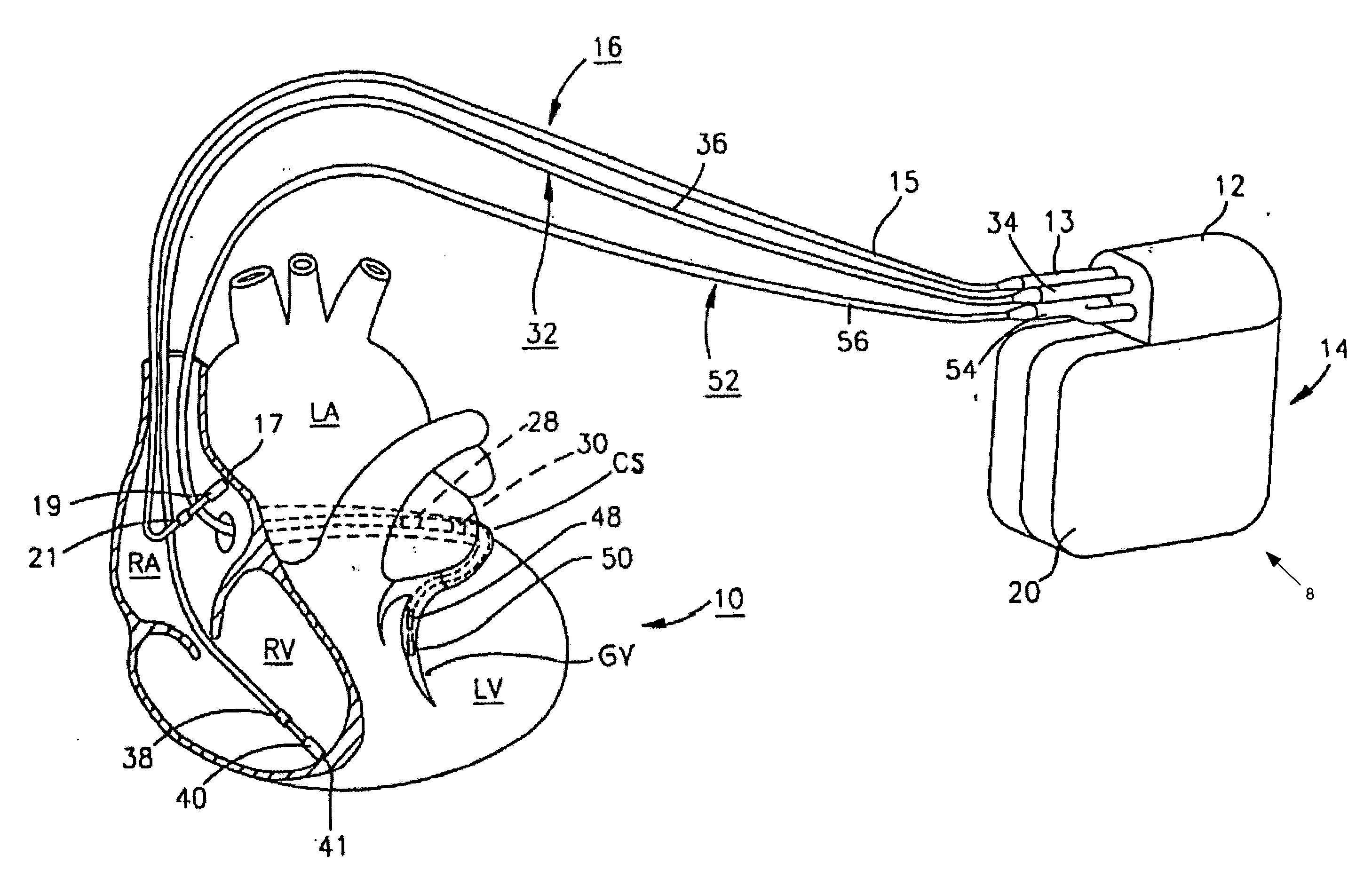 System and method for providing alternative pacing modality selection