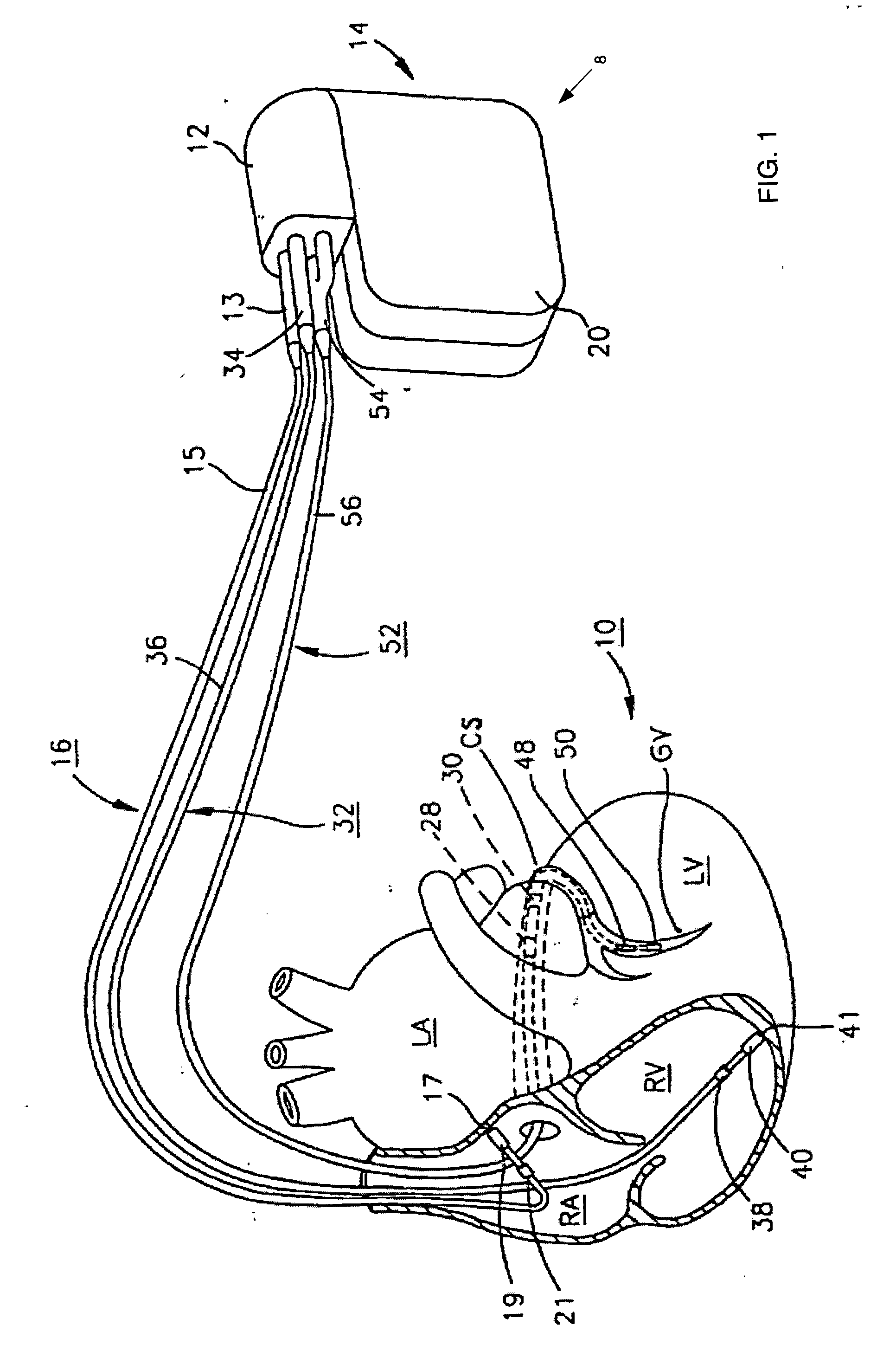 System and method for providing alternative pacing modality selection