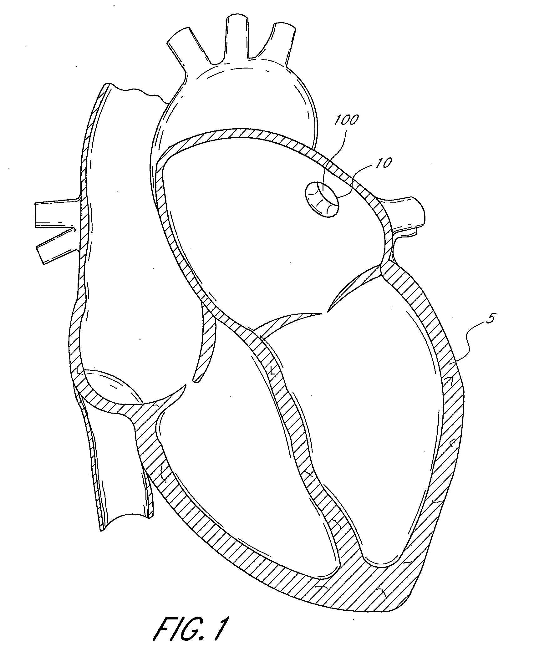 Method and apparatus for delivering an implant without bias to a left atrial appendage