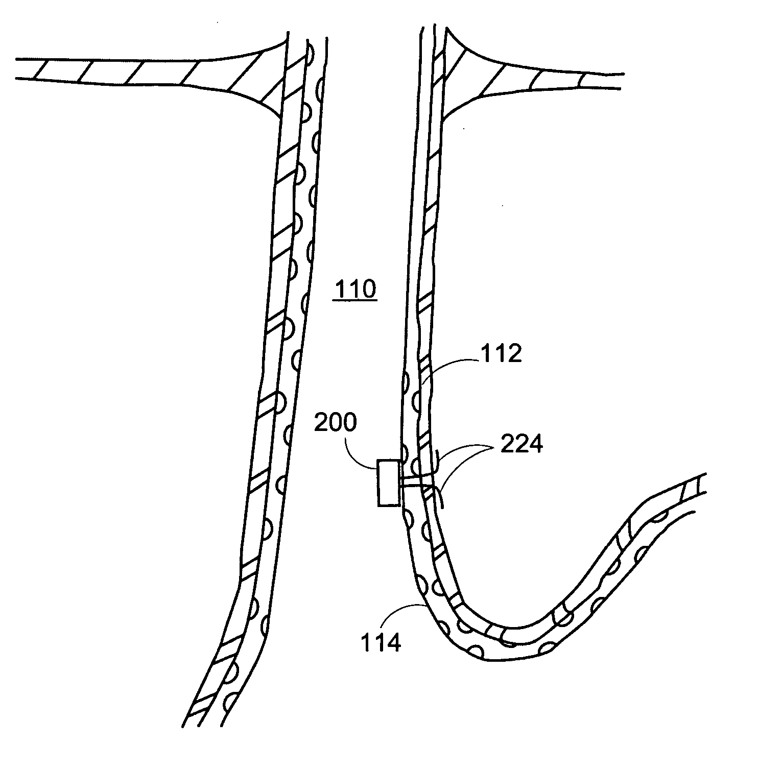 Methods and apparatus for implanting devices into non-sterile body lumens or organs