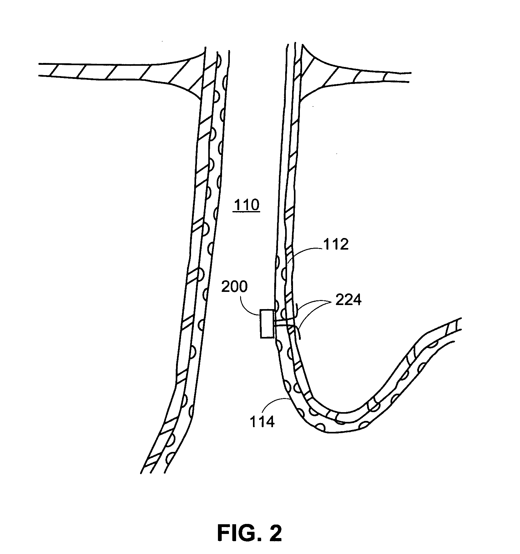 Methods and apparatus for implanting devices into non-sterile body lumens or organs