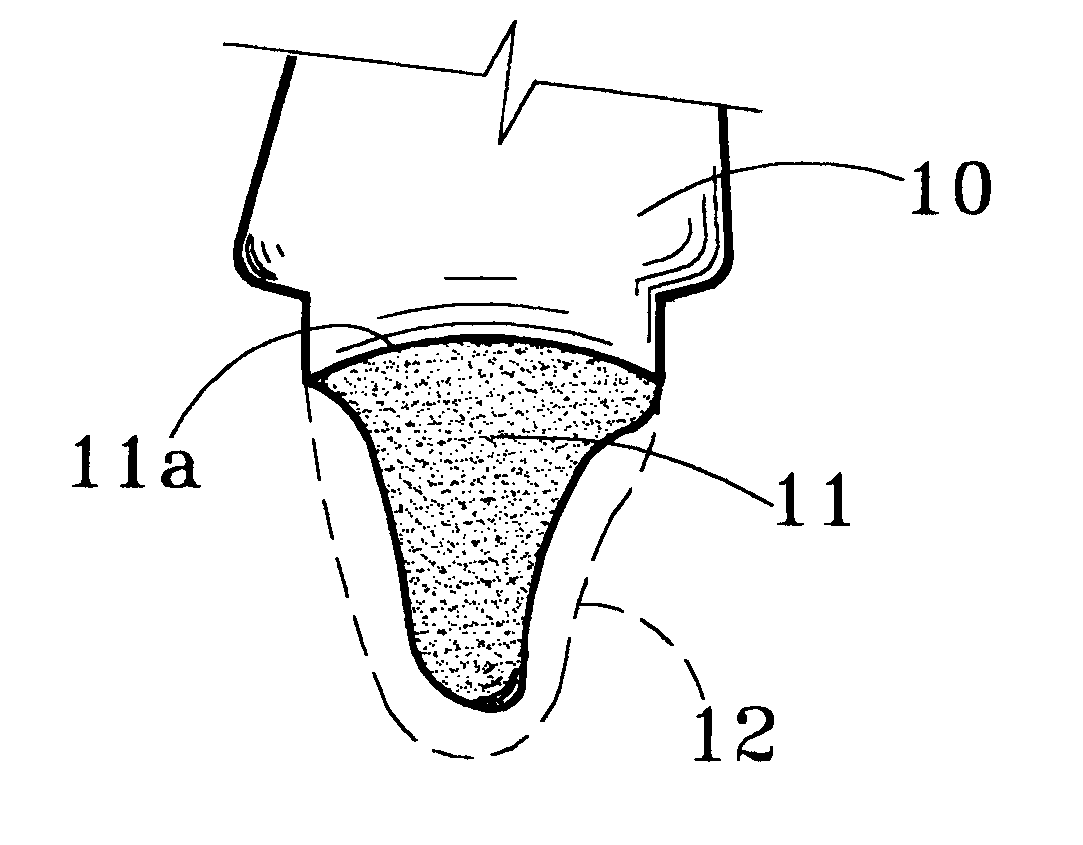 Method of forming tooth restoration