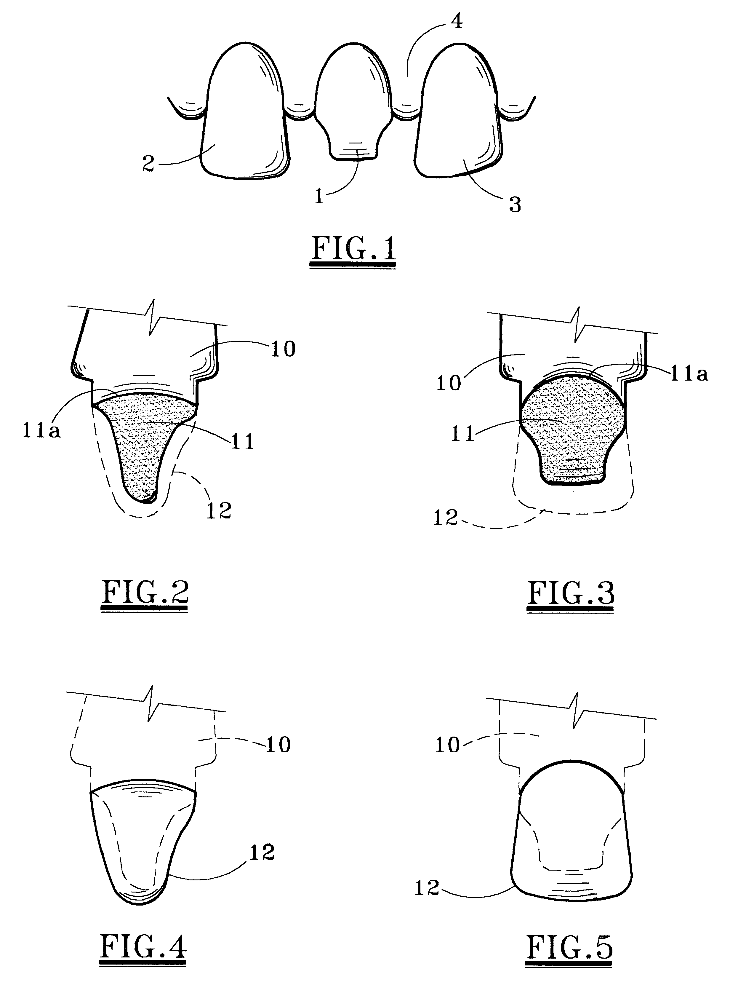 Method of forming tooth restoration
