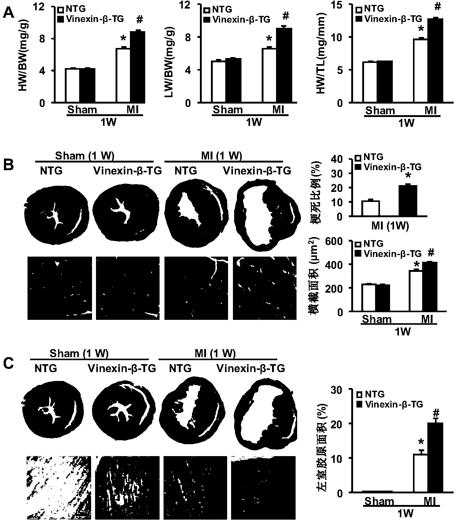 Application of Vinexin-beta gene in coronary atherosclerotic heart disease