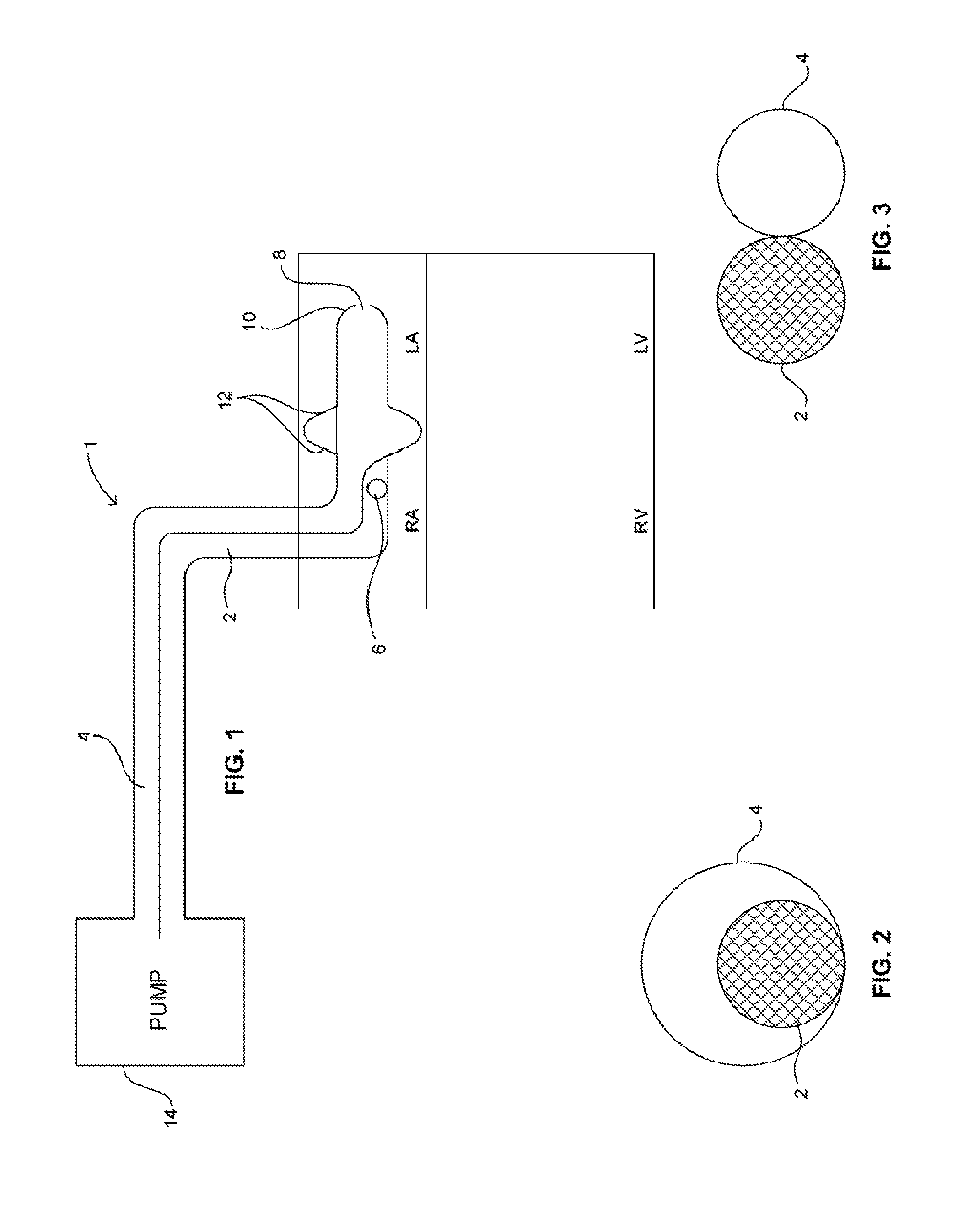 Cardiac support system and methods