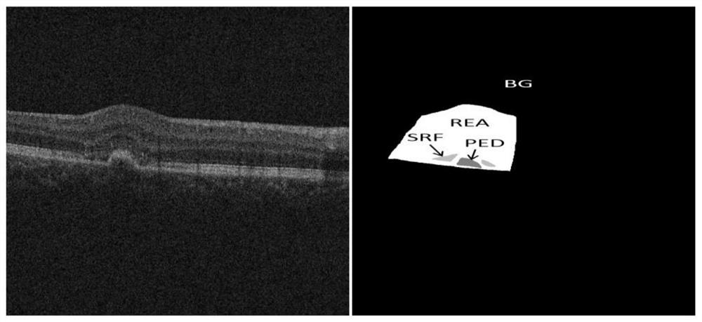 A multi-lesion image segmentation method for retinal macular edema