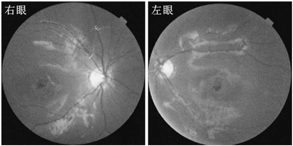 A pathogenic mutation of hereditary cone dystrophy and its detection reagent