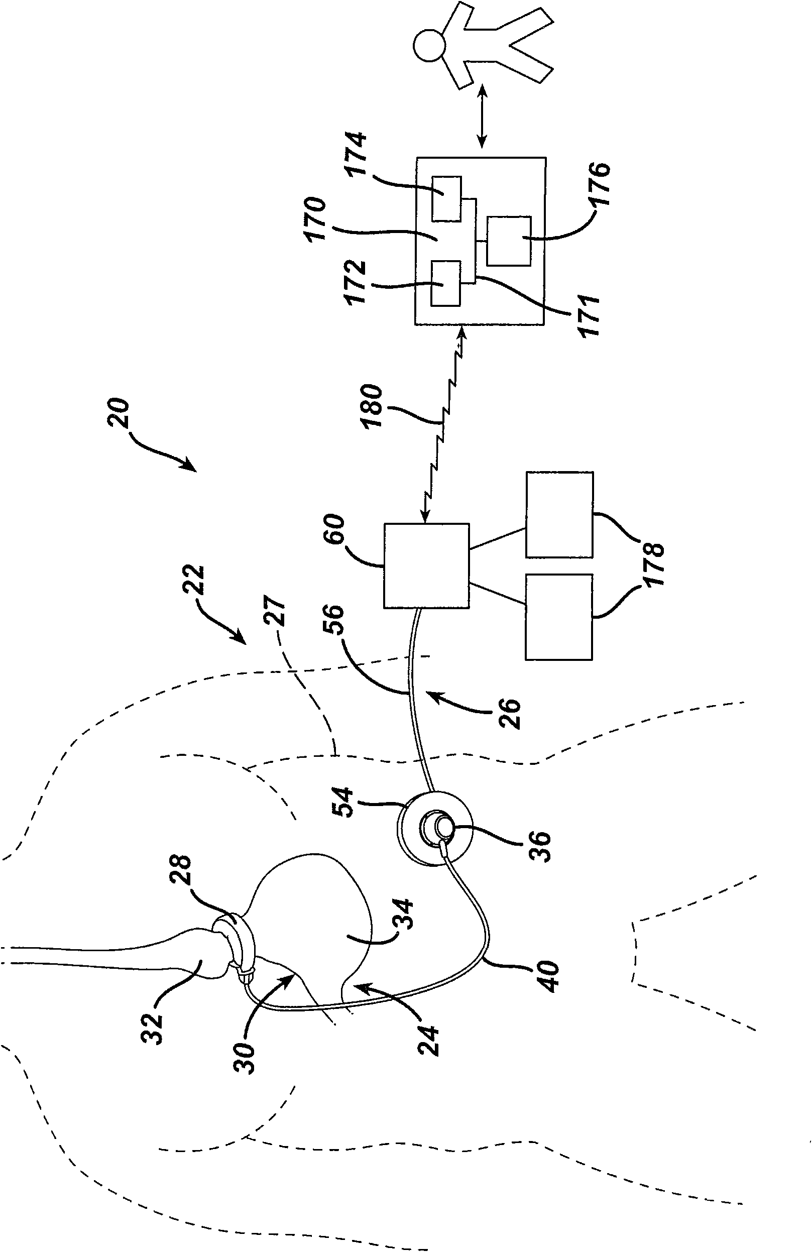 Gui with trend analysis for an implantable restriction device and a data logger