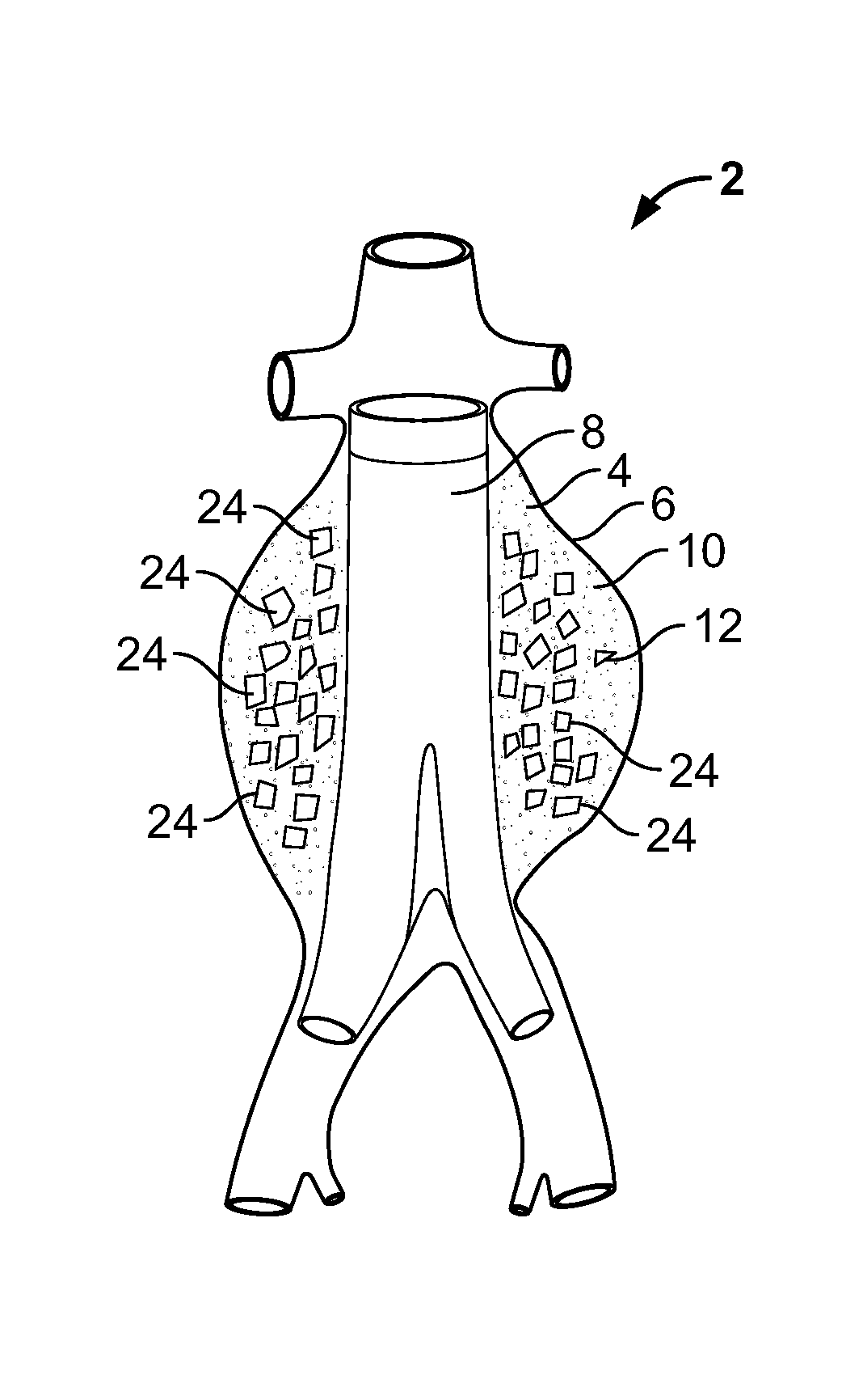 Embolization device and a method of using the same
