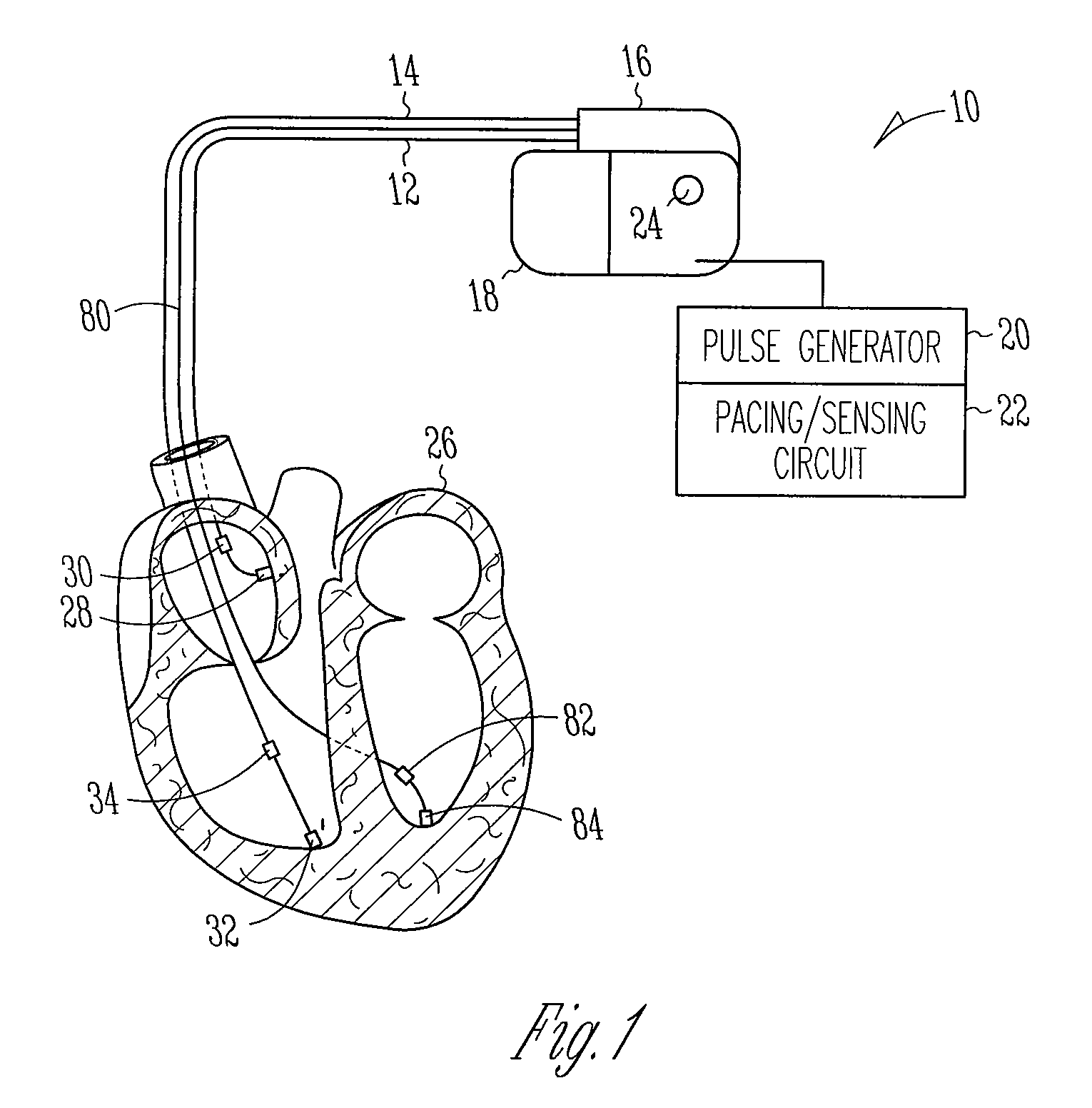 Autocapture pacing/sensing configuration