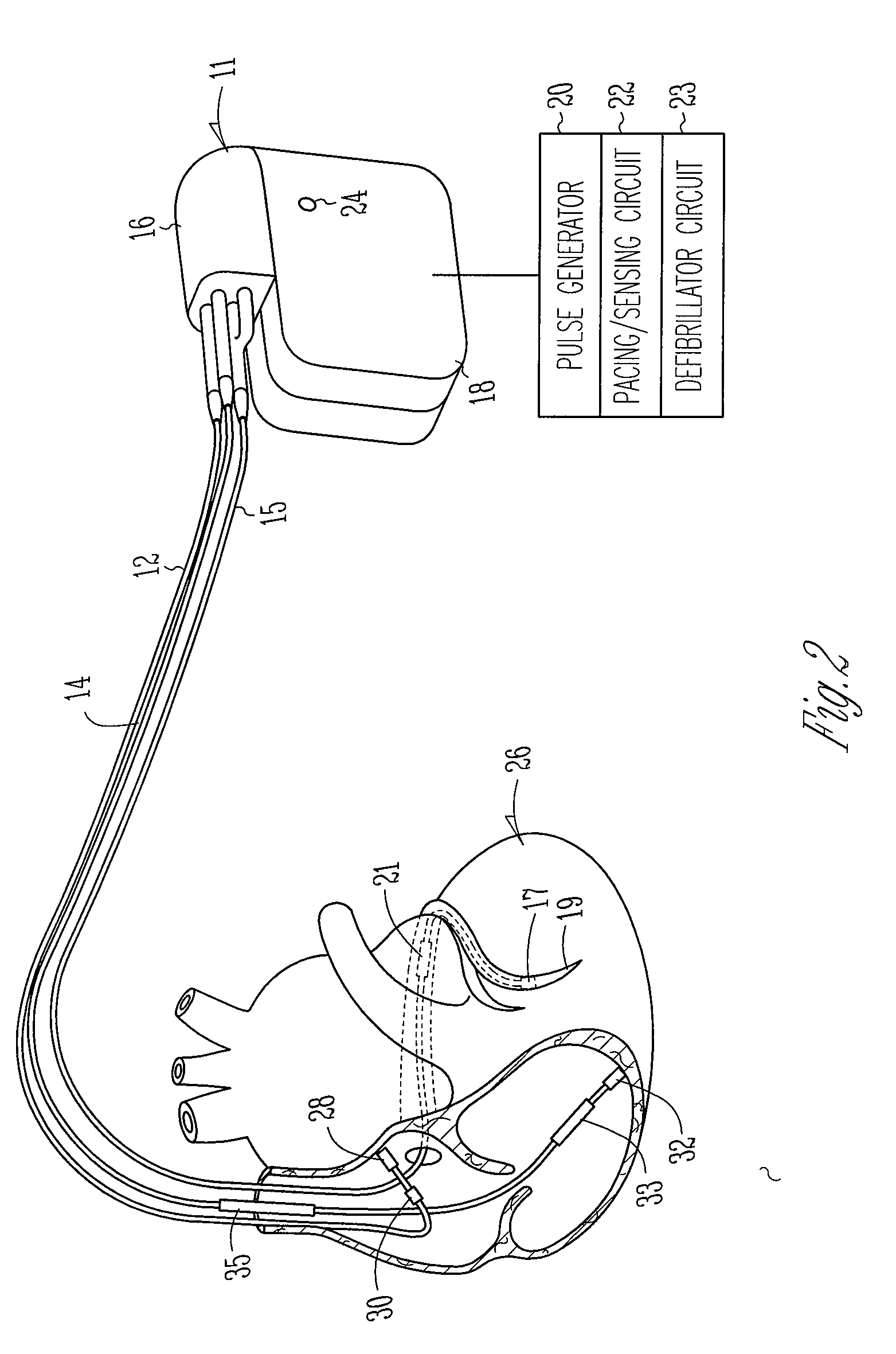 Autocapture pacing/sensing configuration