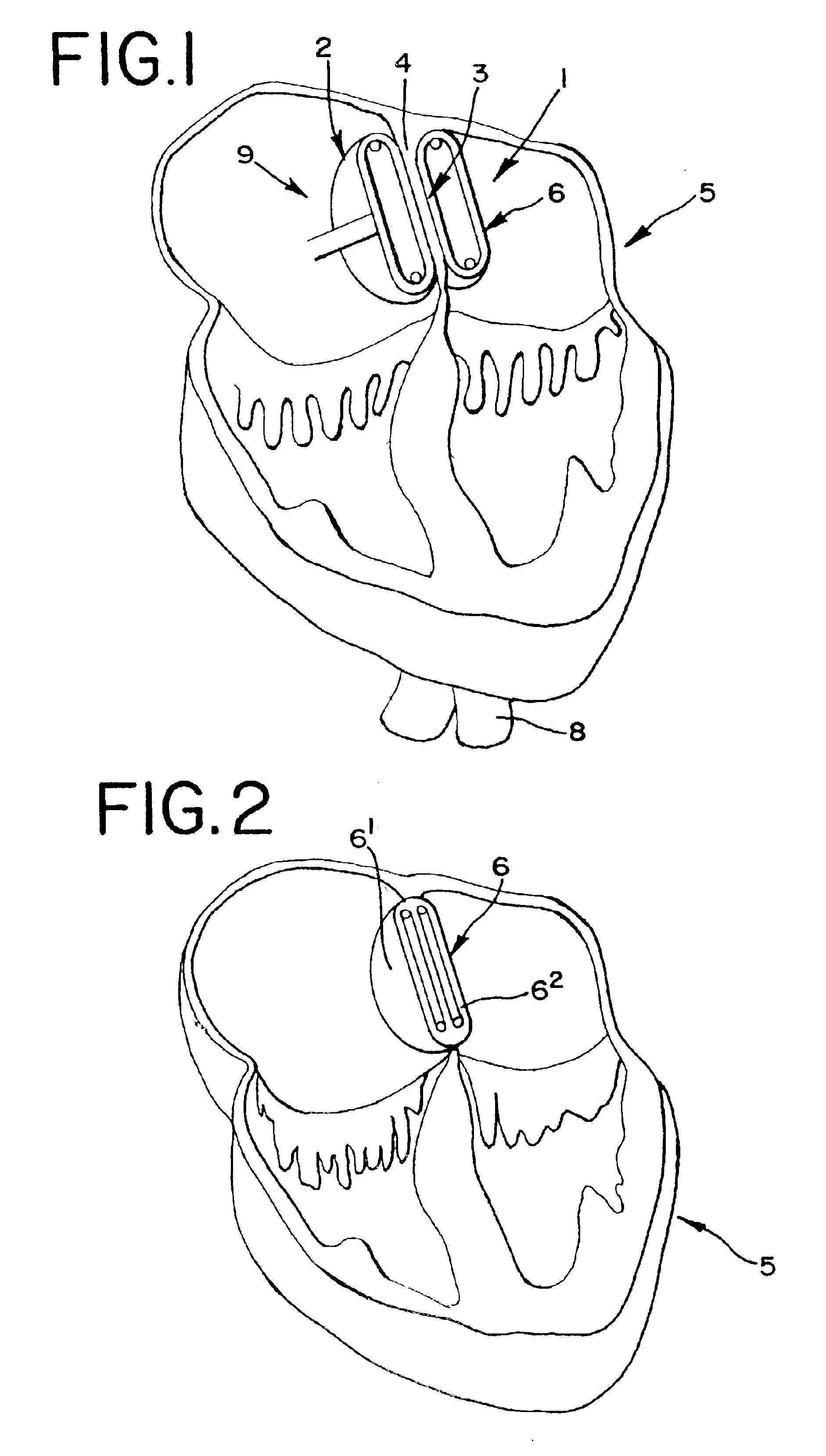 Device for plugging an opening such as in a wall of a hollow or tubular organ including biodegradable elements