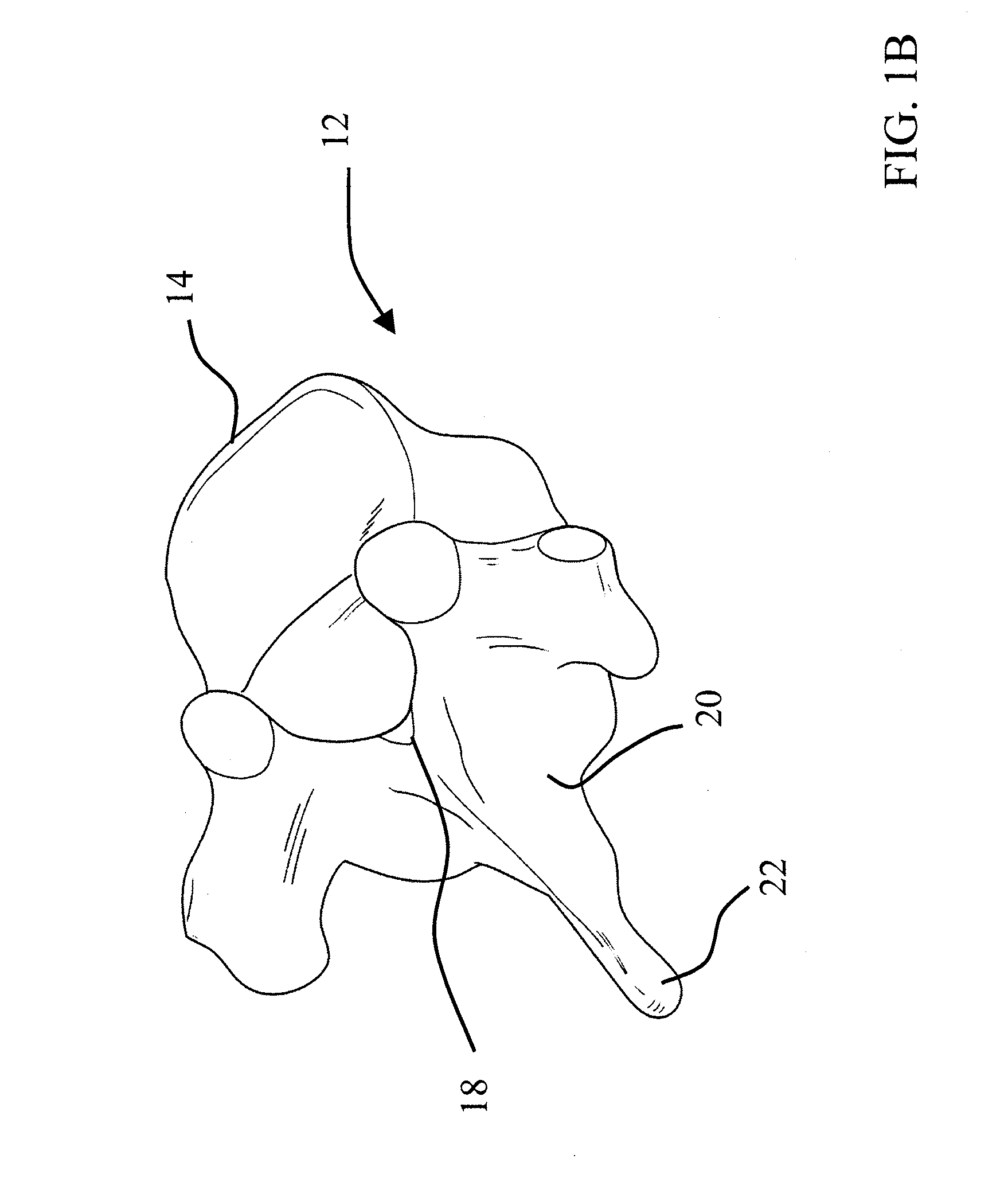 Implantable devices and methods for treating micro-architecture deterioration of bone tissue