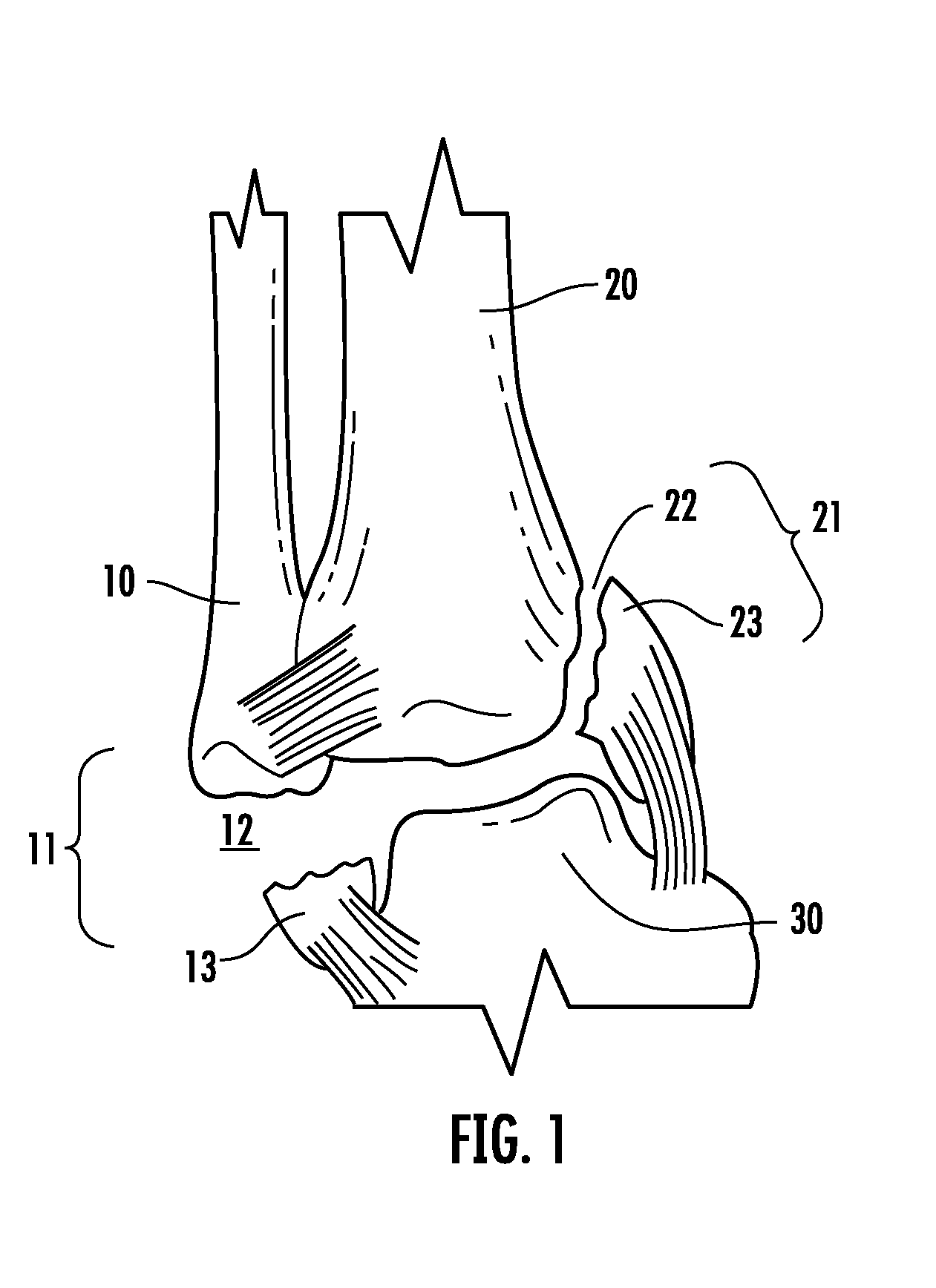 Contoured bone plate for fracture fixation having hook members