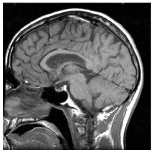 A Multimodal Medical Image Fusion Method Based on Low-rank Decomposition and Sparse Representation