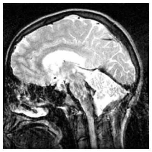 A Multimodal Medical Image Fusion Method Based on Low-rank Decomposition and Sparse Representation