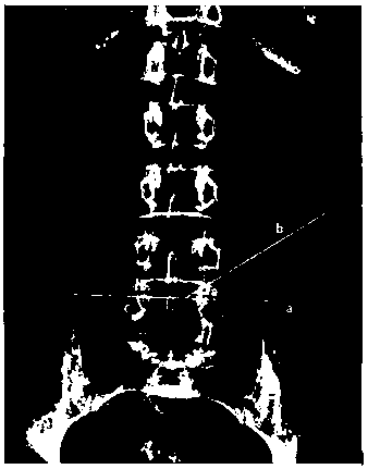Novel three-axis adjusting type precise spine puncture positioning apparatus