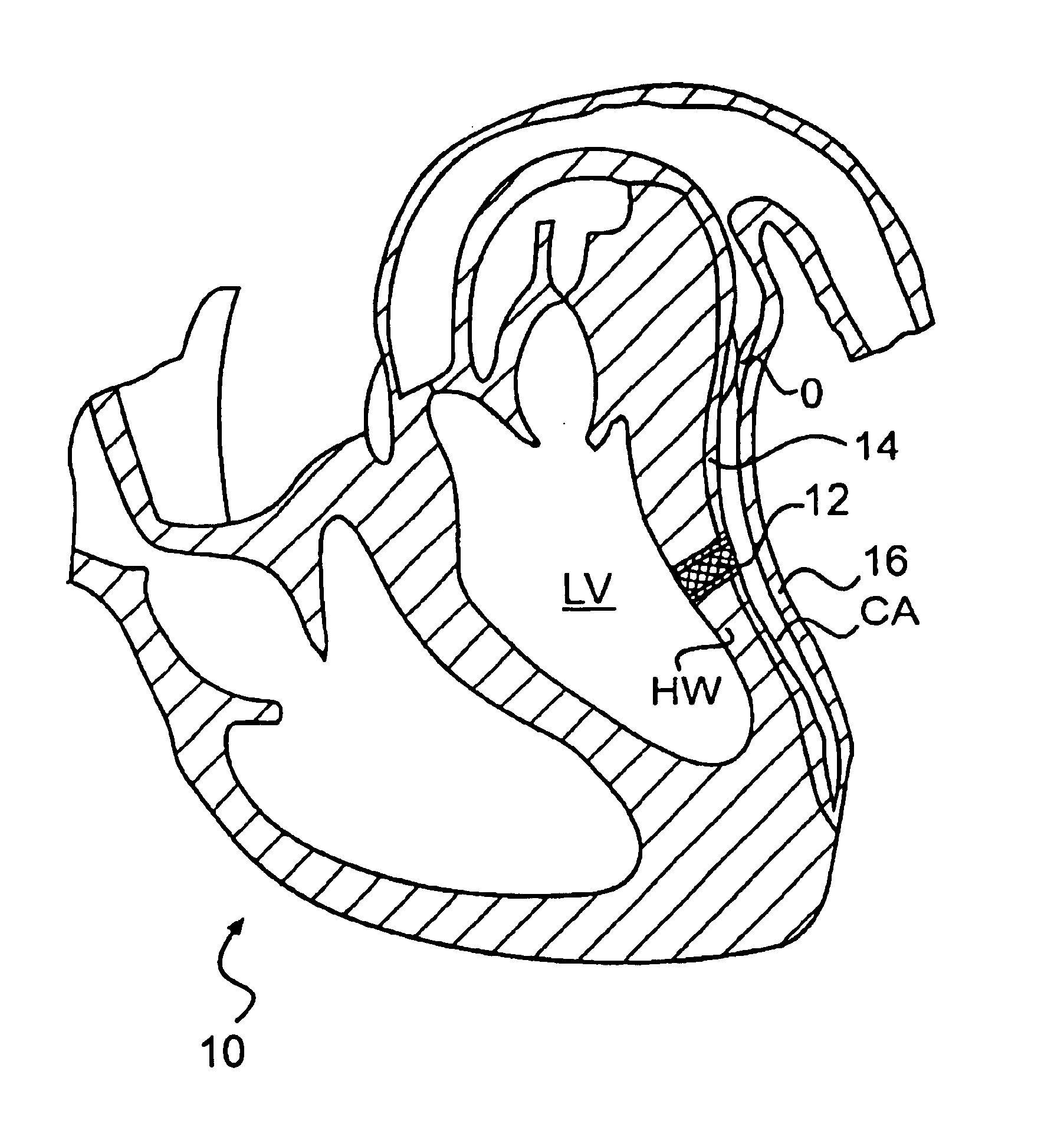 Methods and devices for delivering a ventricular stent