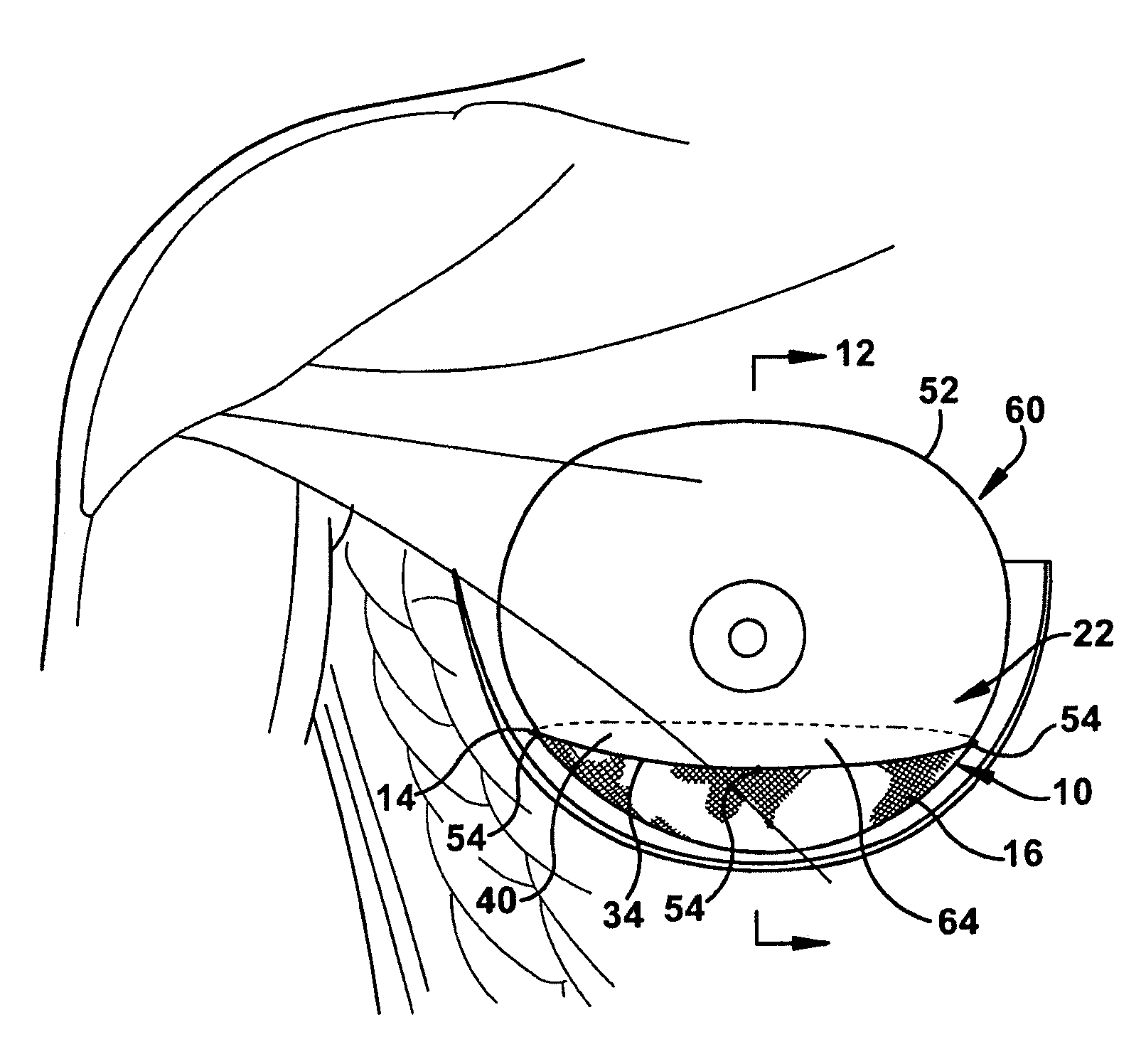 Implantable prosthesis for positioning and supporting a breast implant