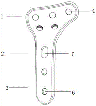 Degradable proximal tibia posterior-lateral locking internal fixation apparatus with development functions