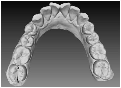A Segmentation Method of 3D Teeth Mesh Data Based on Harmonic Field Algorithm