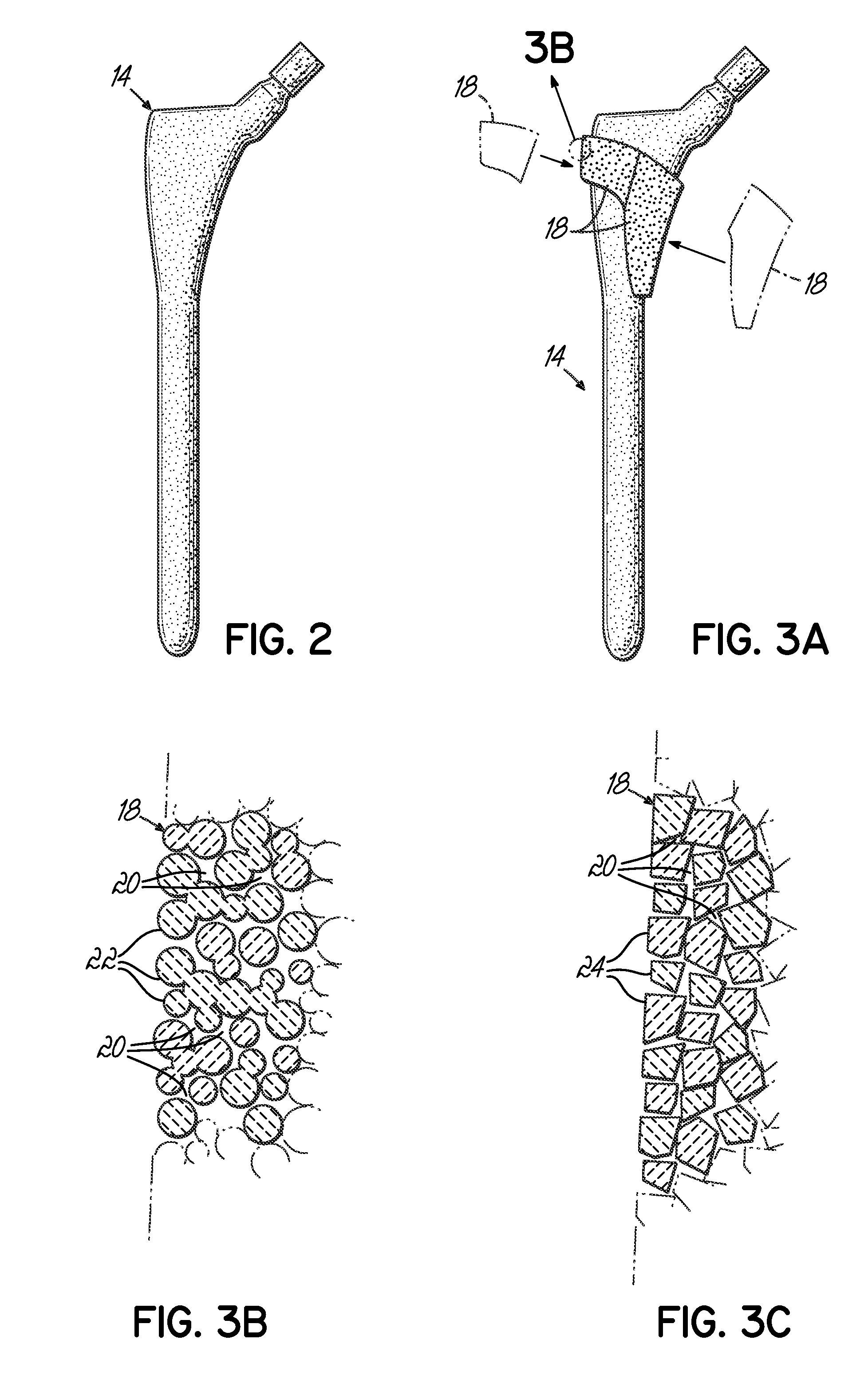 Method for forming an integral porous region in a cast implant