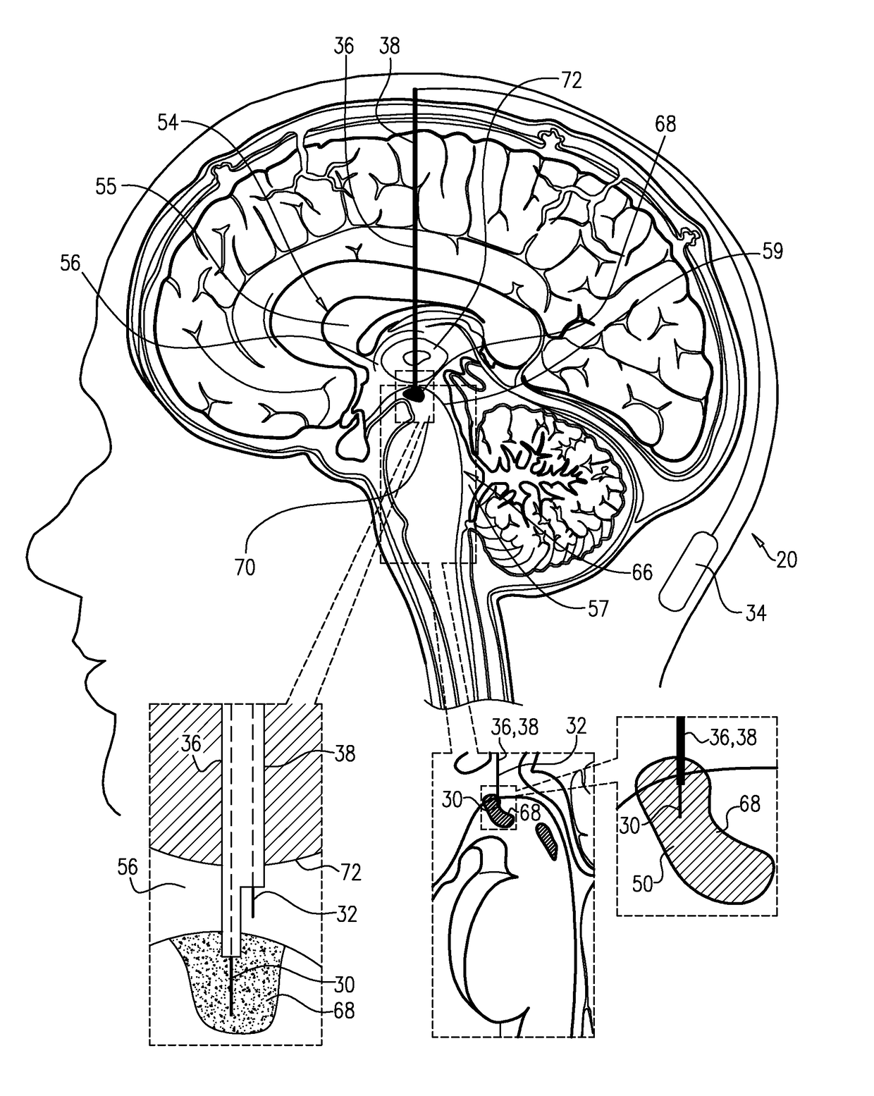 Electrical treatment of parkinson's disease