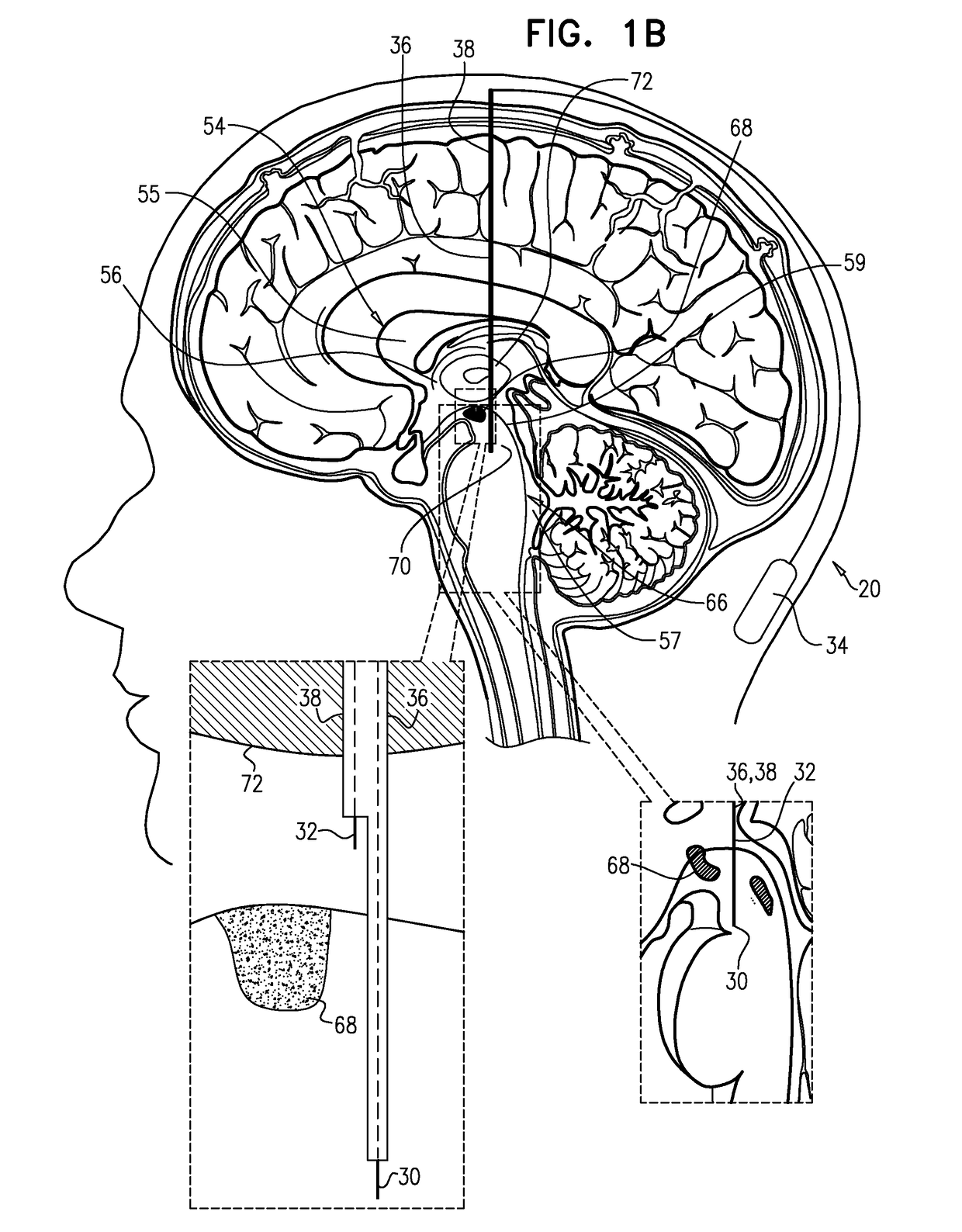 Electrical treatment of parkinson's disease