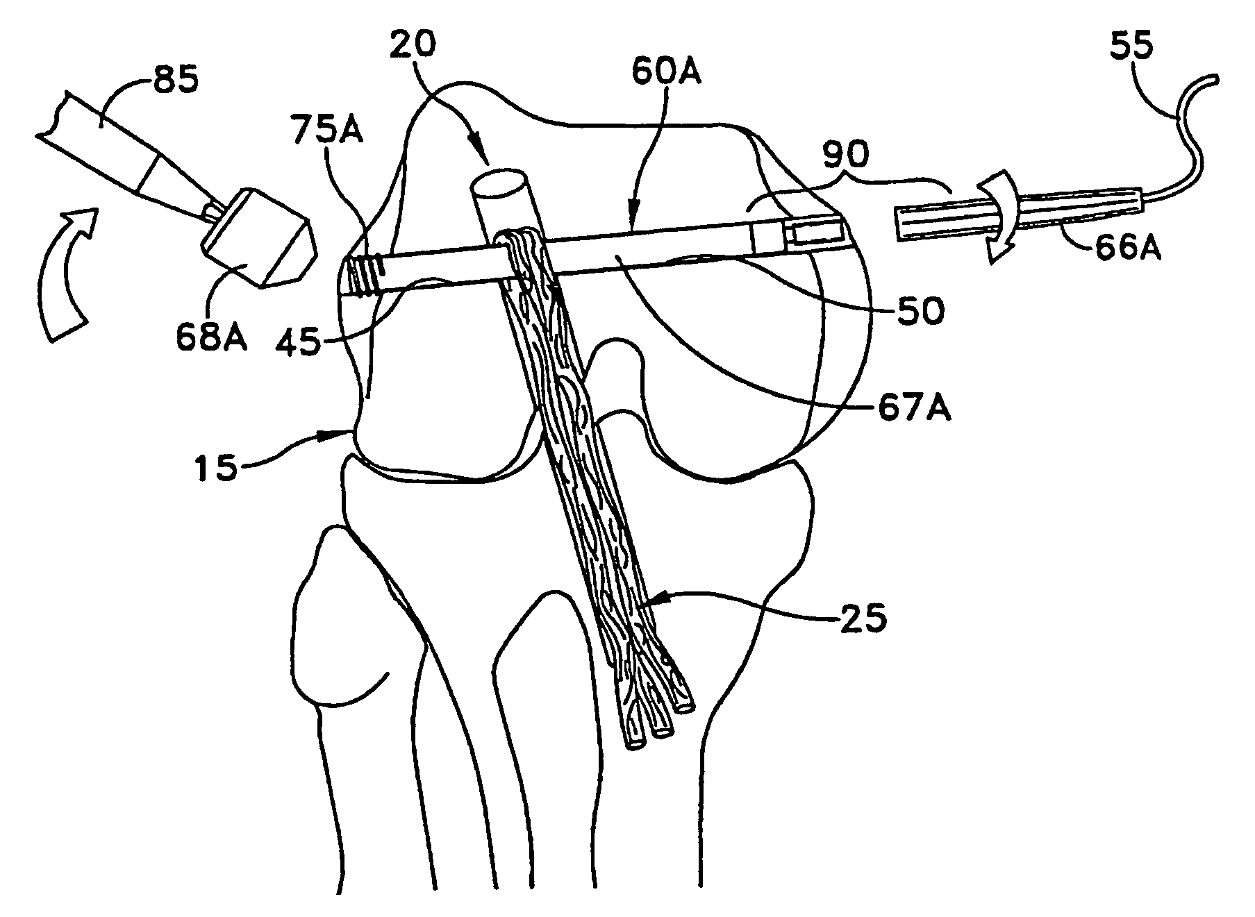 Apparatus and method for reconstructing a ligament