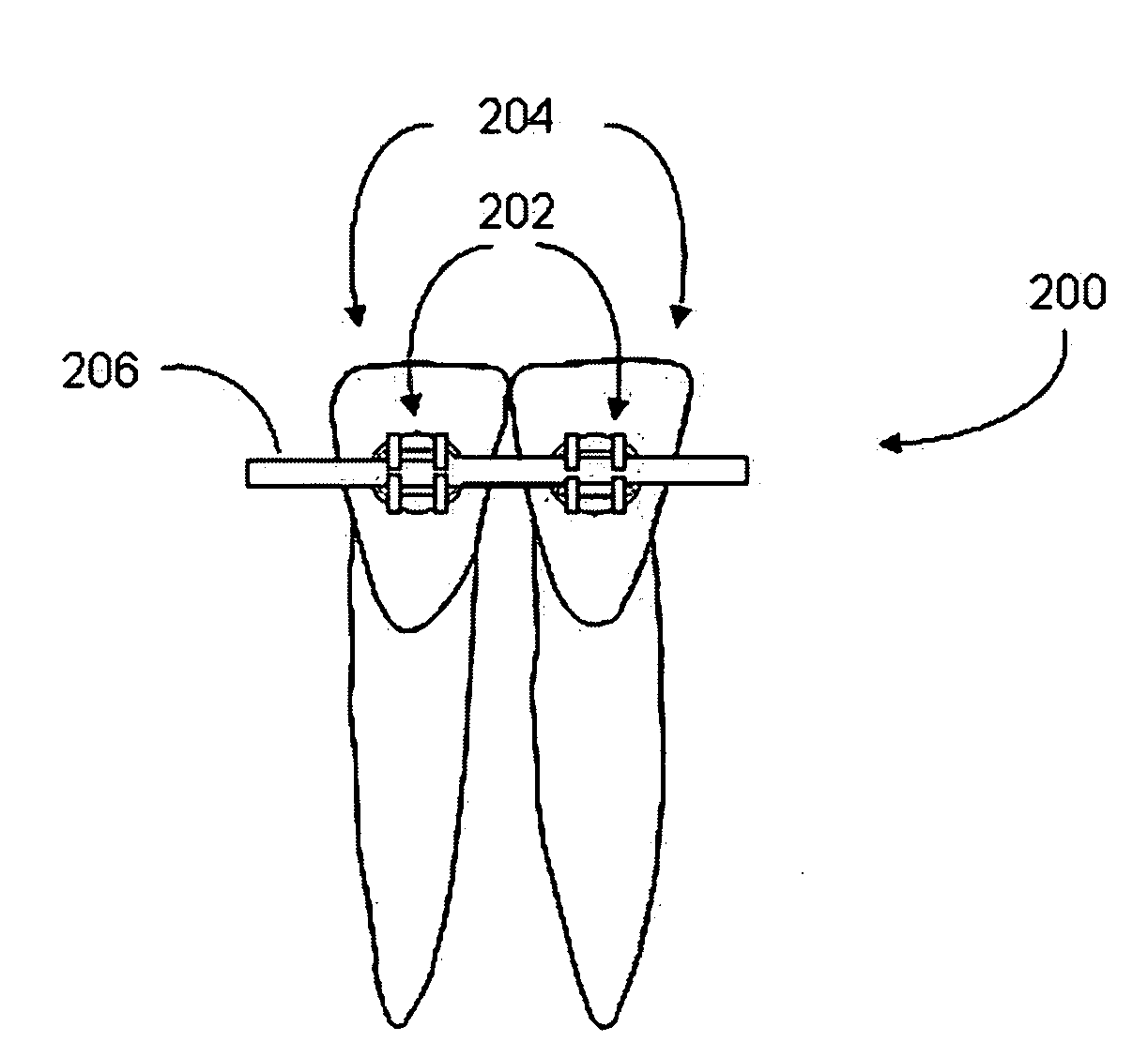System and method for orthodontic retention