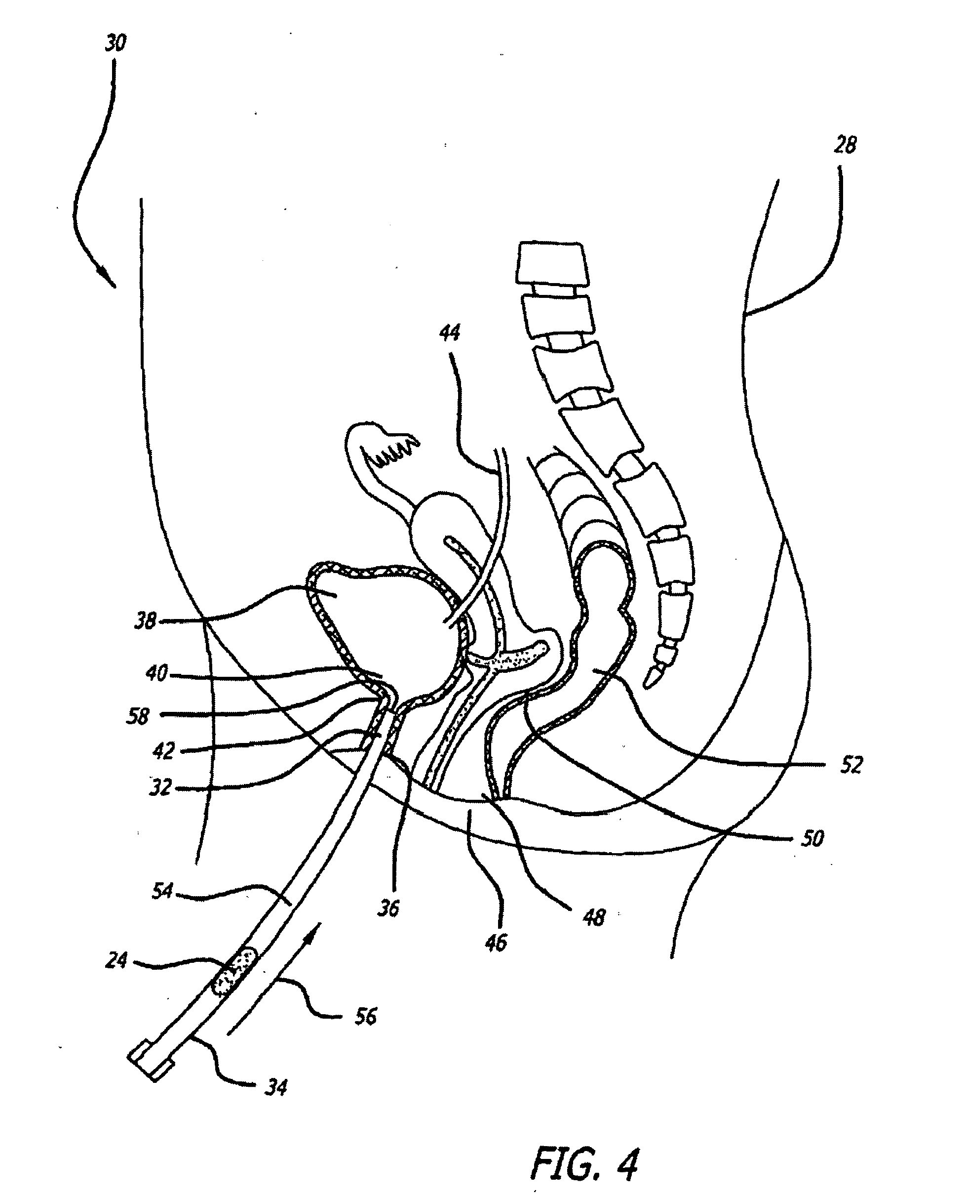 Transluminal drug delivery methods and devices